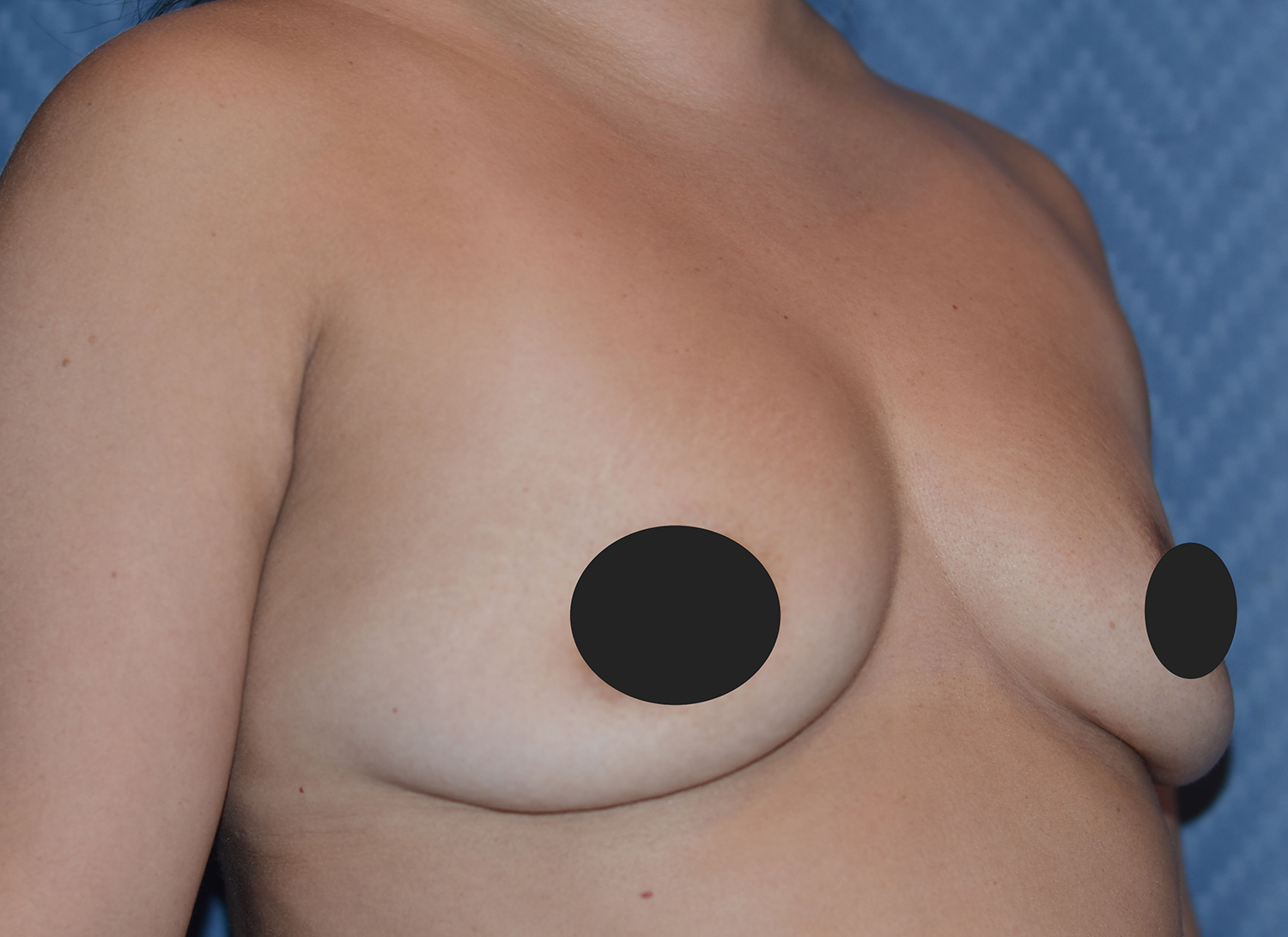 Before Image: Breast Fat Transfer - right-front-oblique