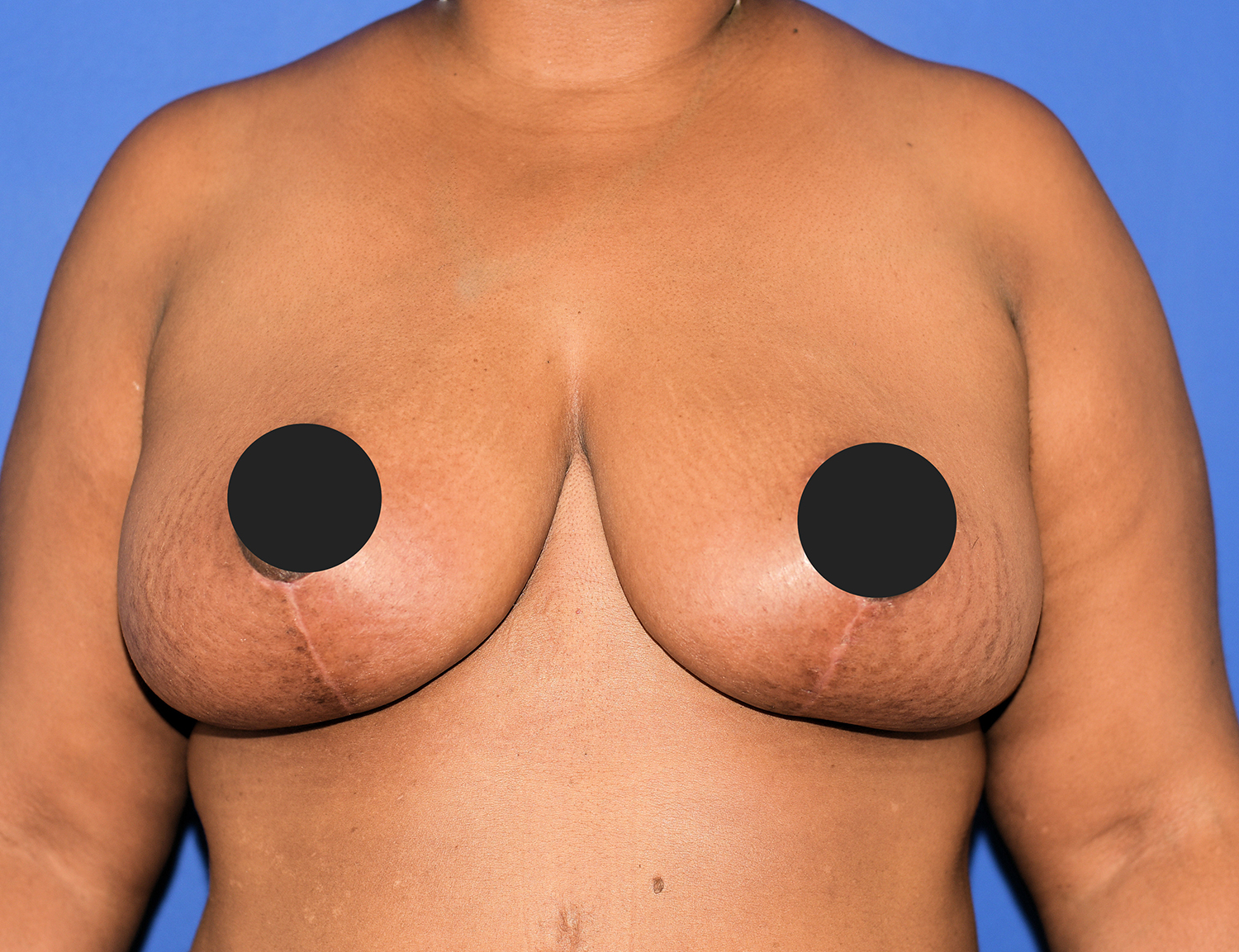 After Image: Breast Lift - front