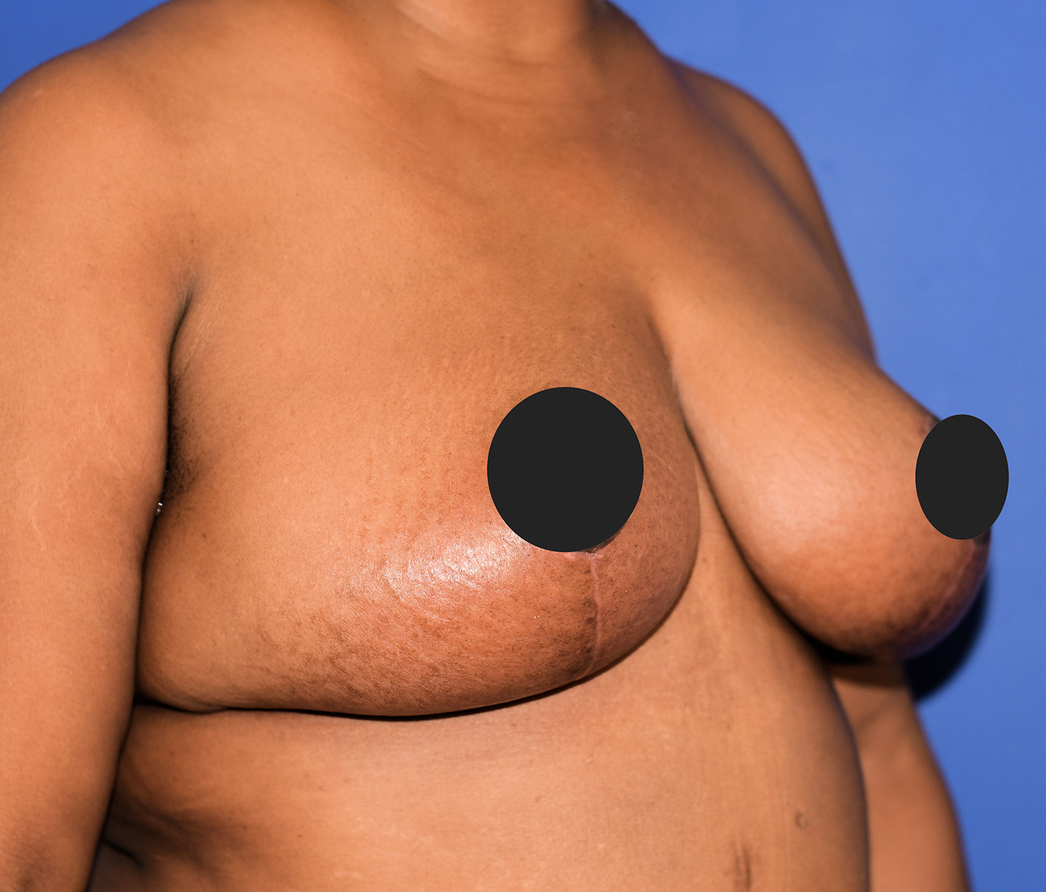 After Image: Breast Lift - right-front-oblique
