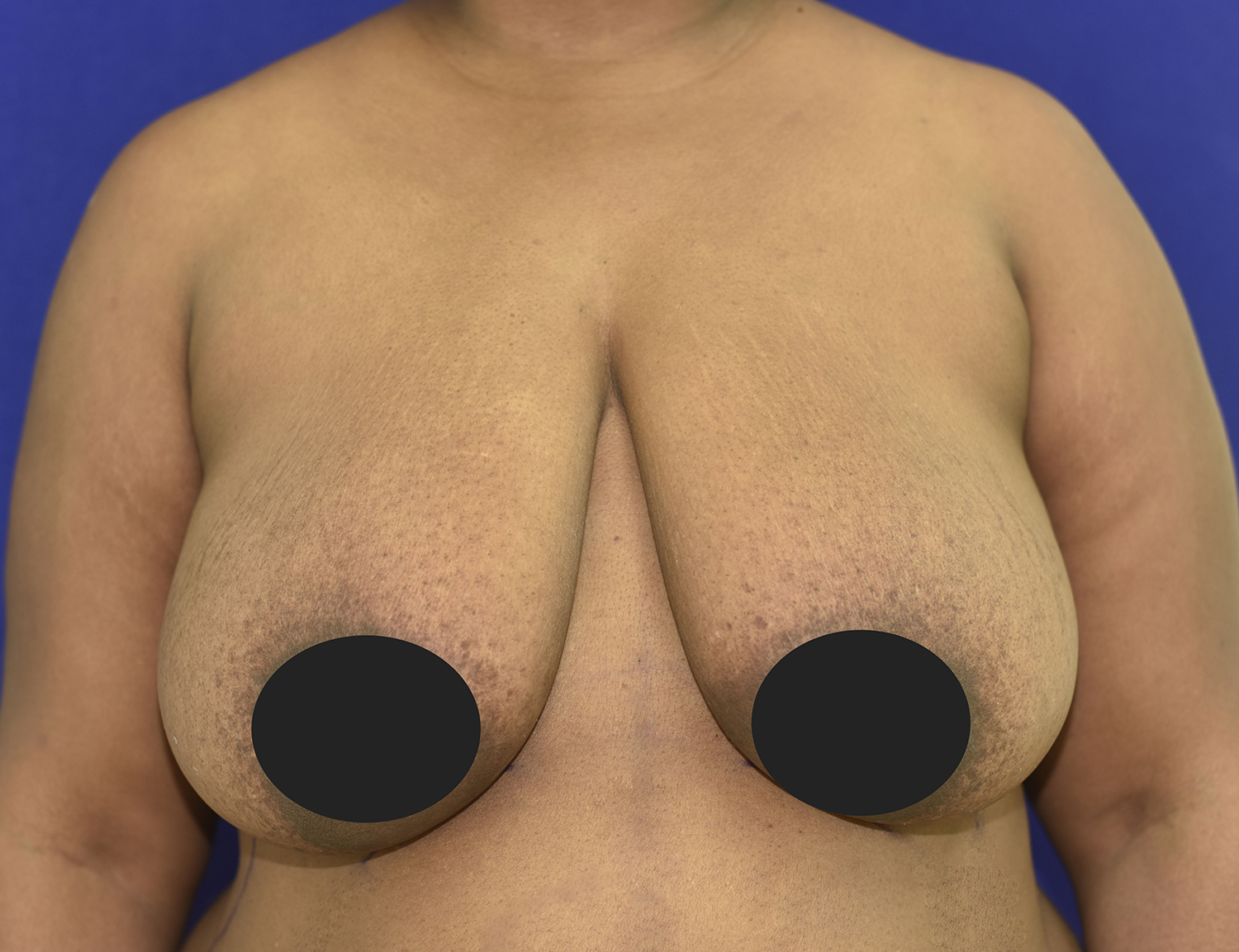 Before Image: Breast Lift - front