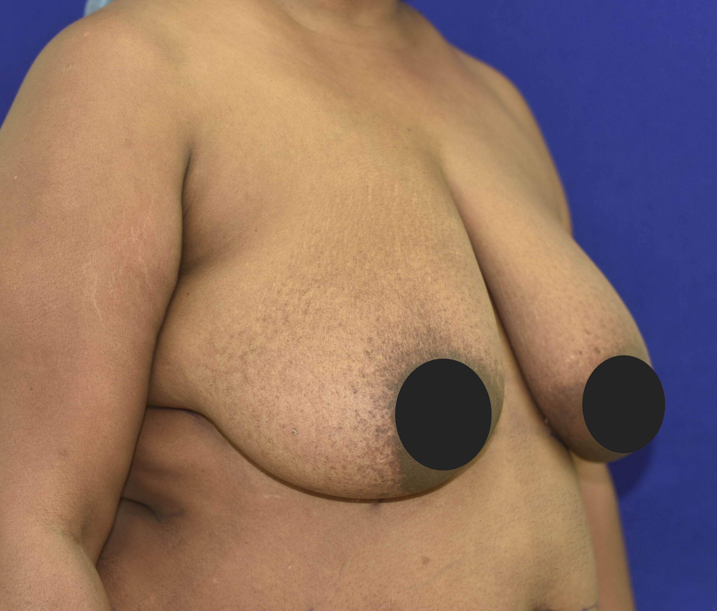 Before Image: Breast Lift - right-front-oblique
