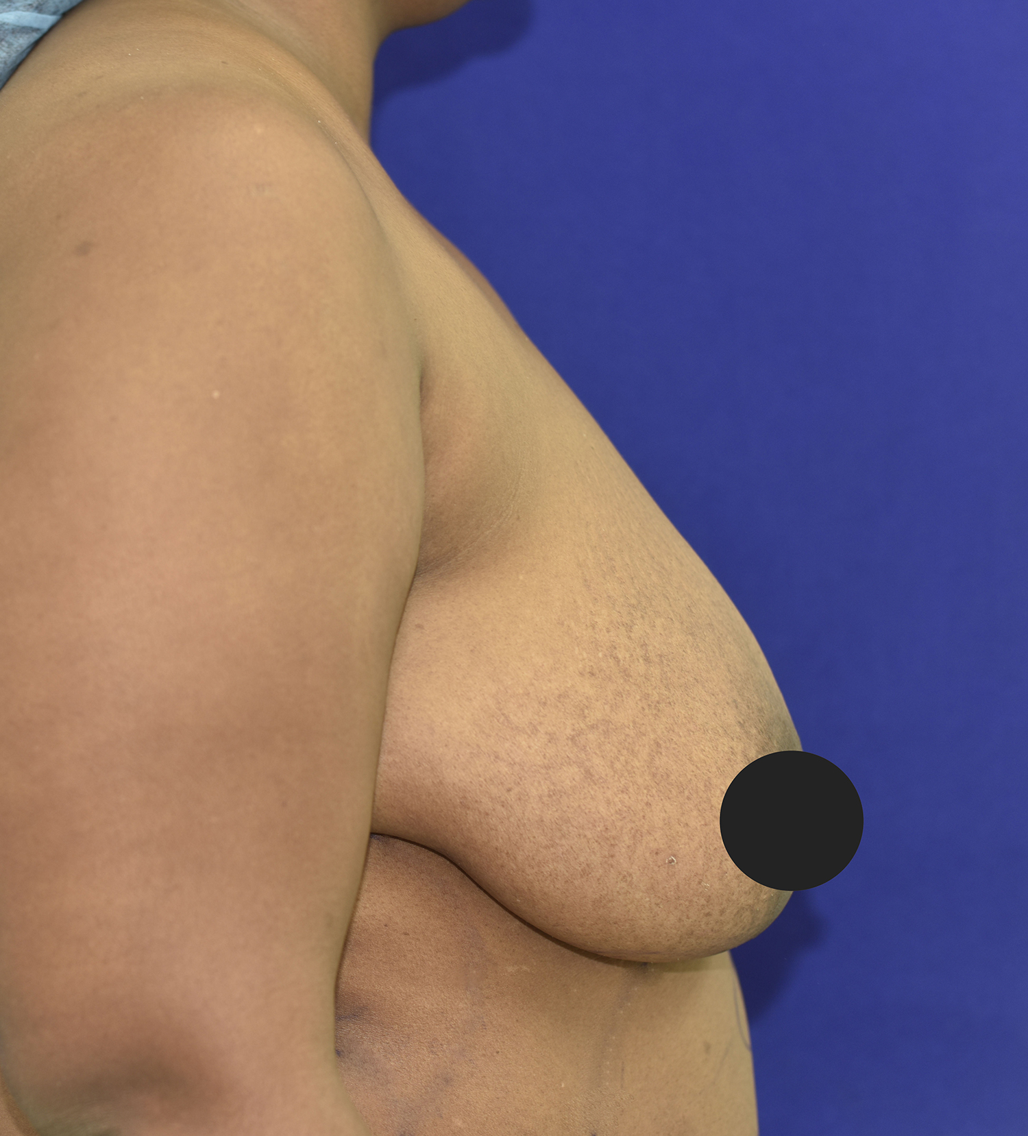 Before Image: Breast Lift - right-side