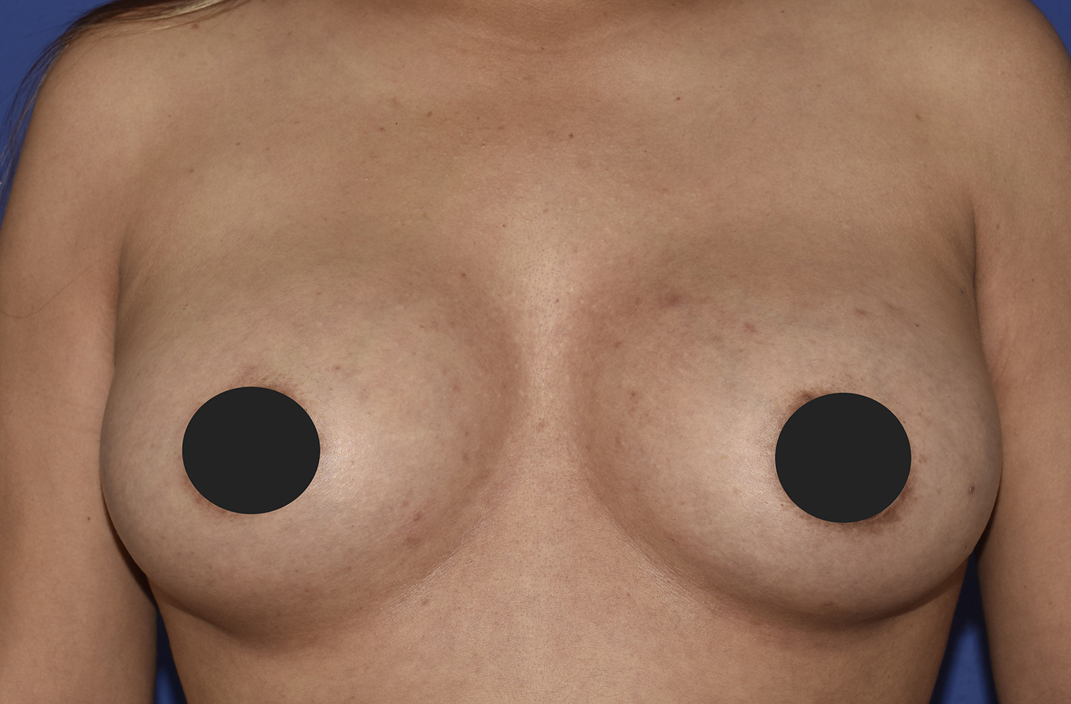 After Image: Breast Augmentation - front