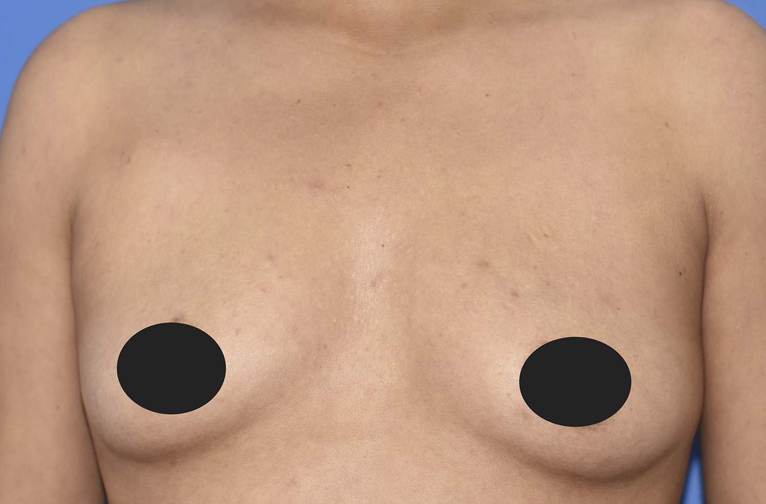Before Image: Breast Augmentation - front
