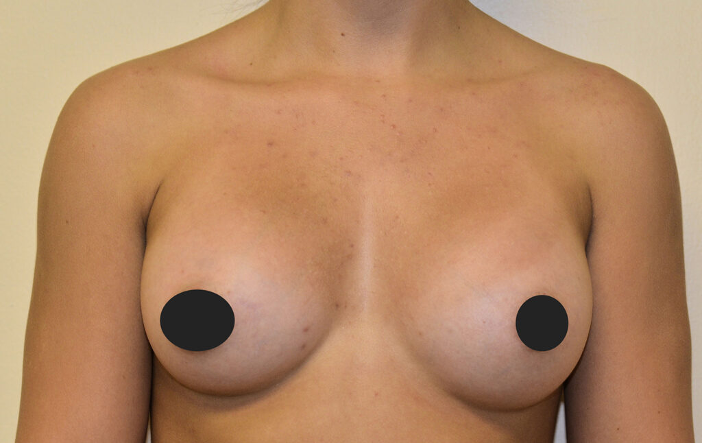 After Image: Breast Augmentation - front