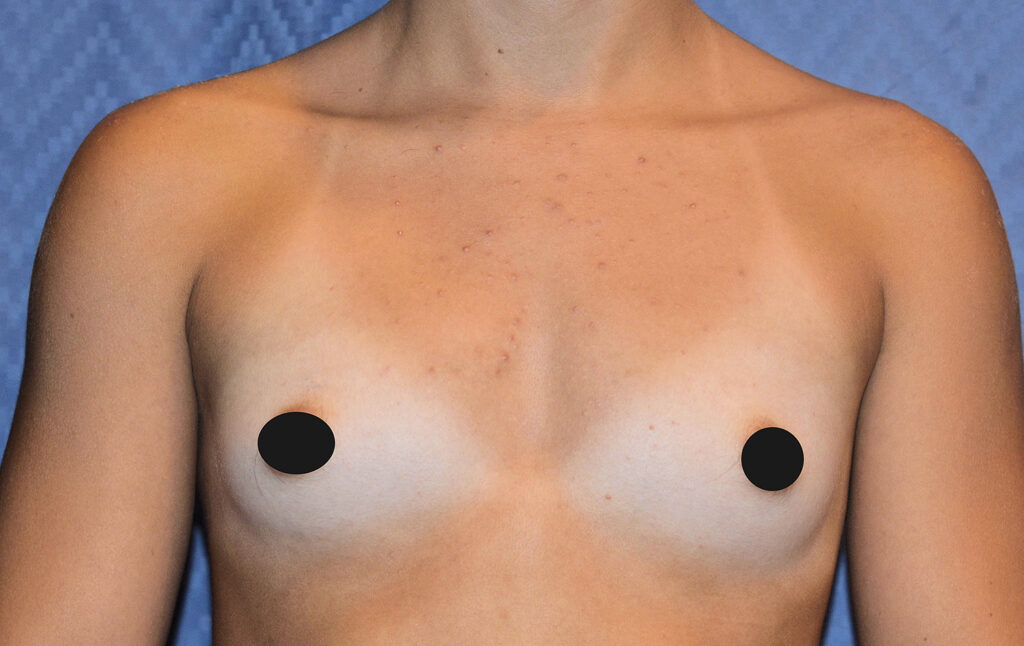 Before Image: Breast Augmentation - front