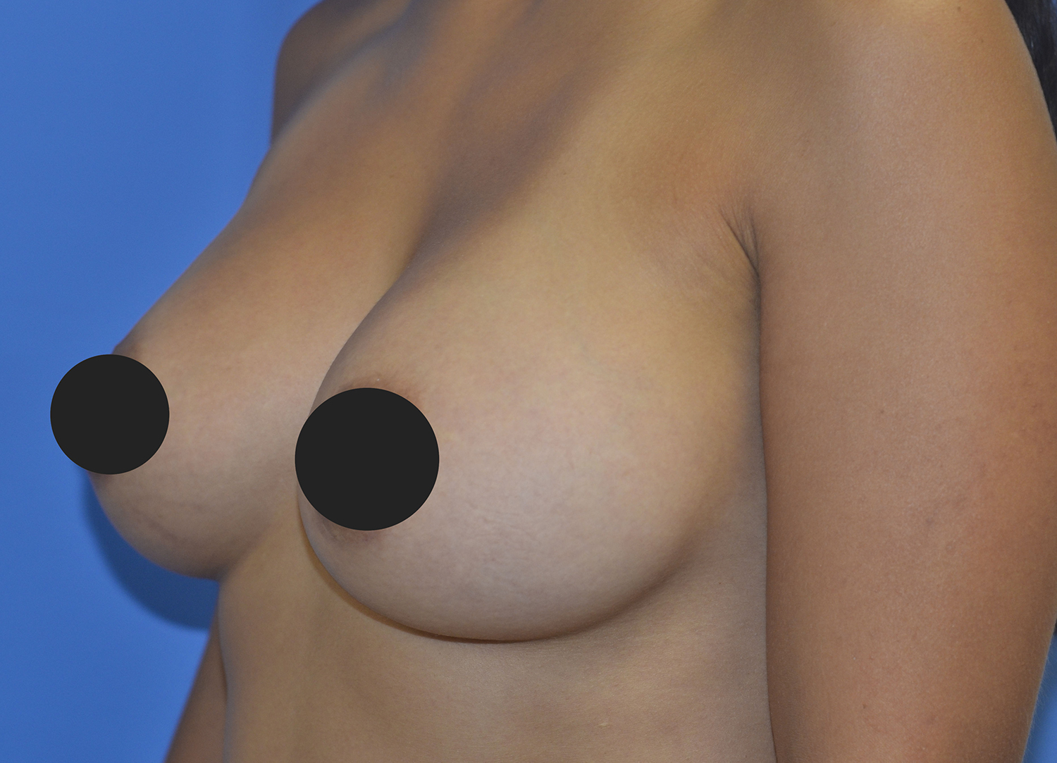 After Image: Breast Augmentation - left-front-oblique