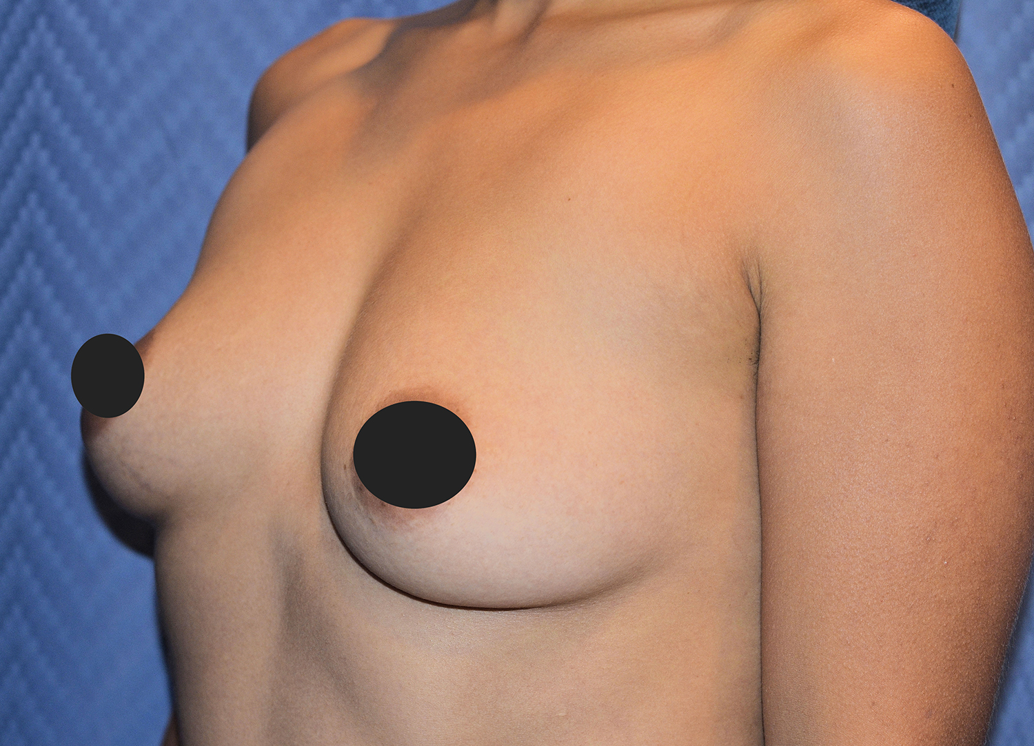 Before Image: Breast Augmentation - left-front-oblique