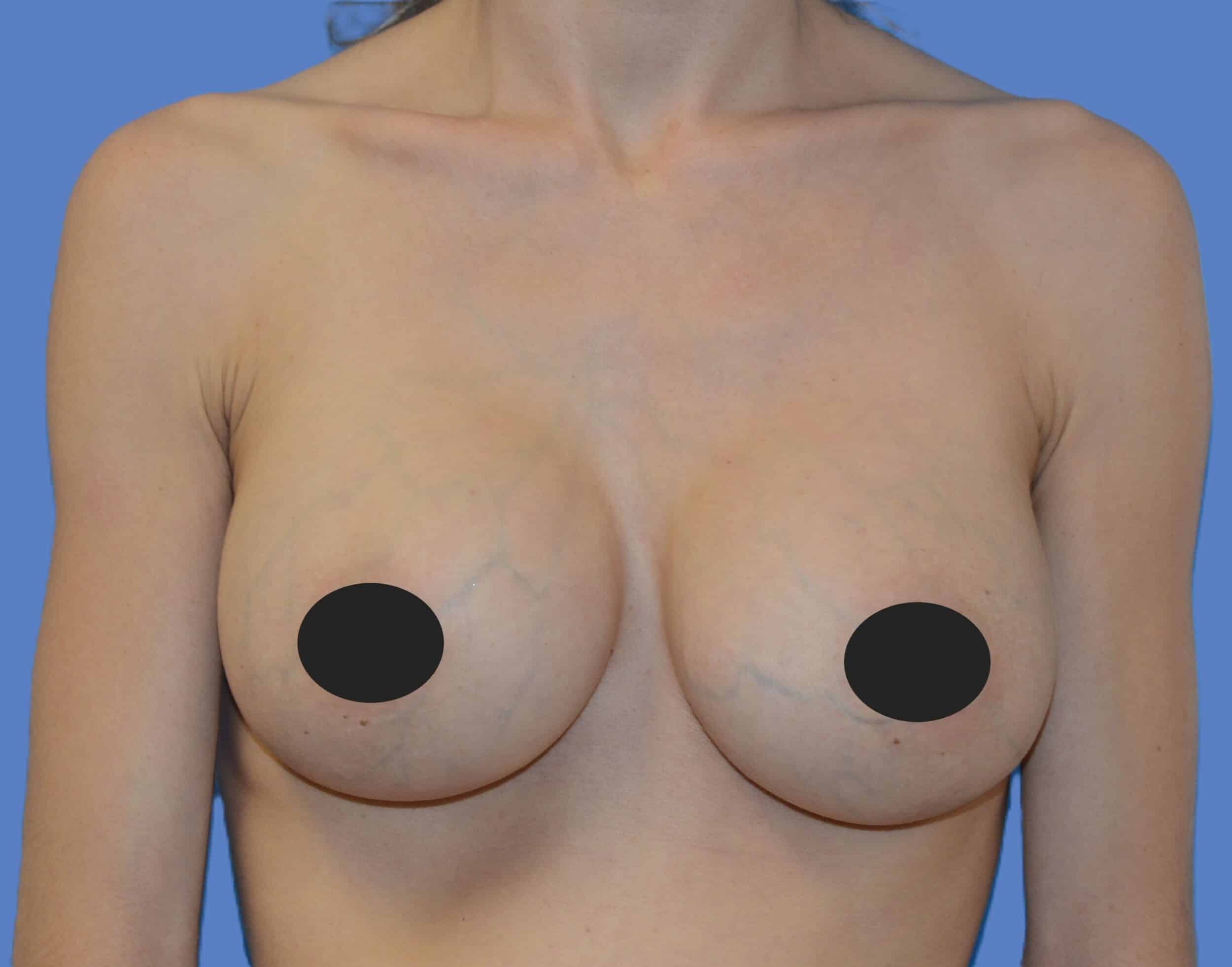 After Image: Breast Reaugmentation - front
