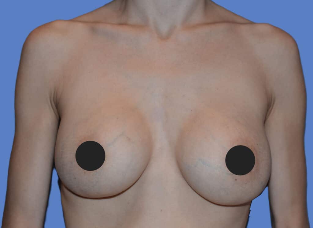 Before Image: Breast Reaugmentation - front