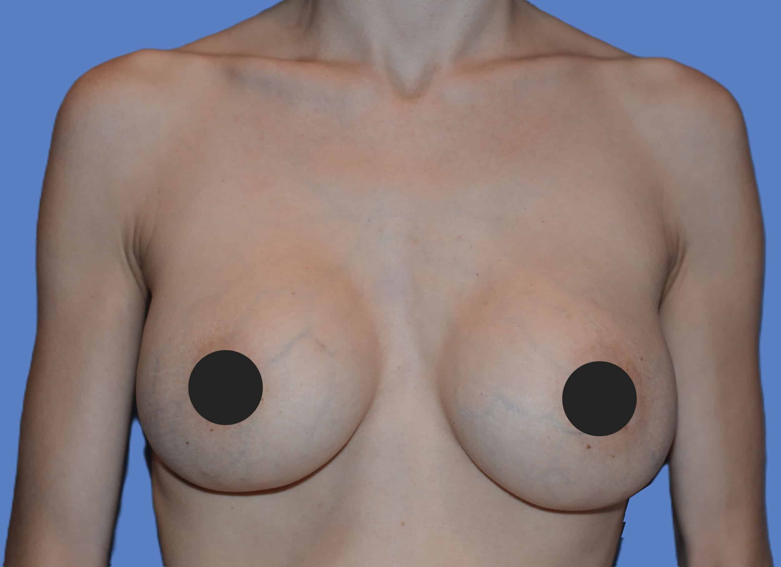 Before Image: Breast Reaugmentation - front