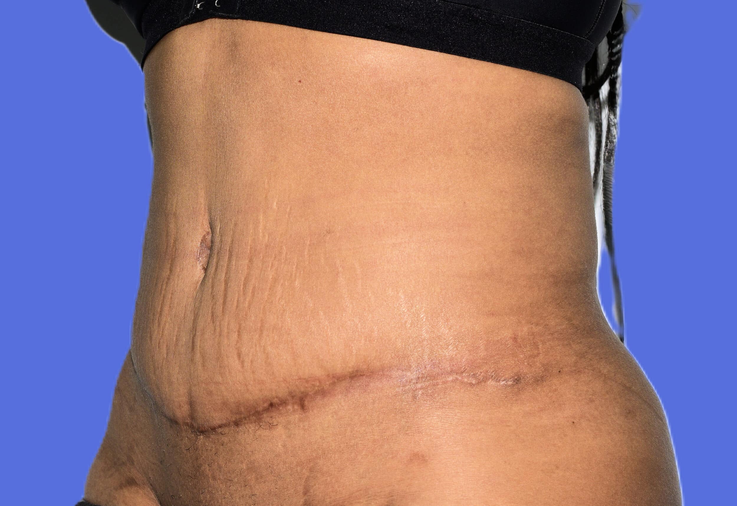 After Image: Tummy Tuck After Abdominal Liposuction - left-front-oblique