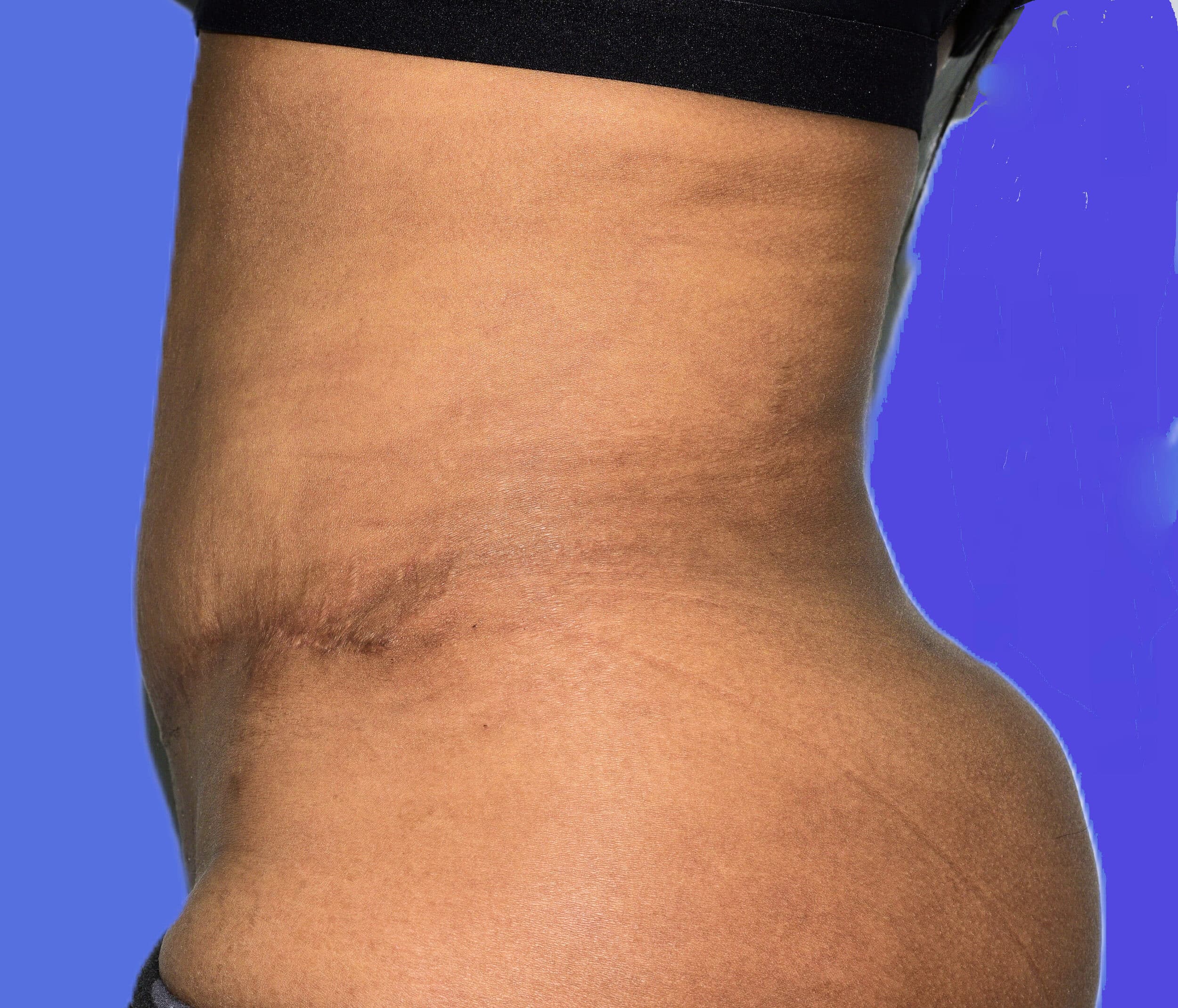 After Image: Tummy Tuck After Abdominal Liposuction - left-side