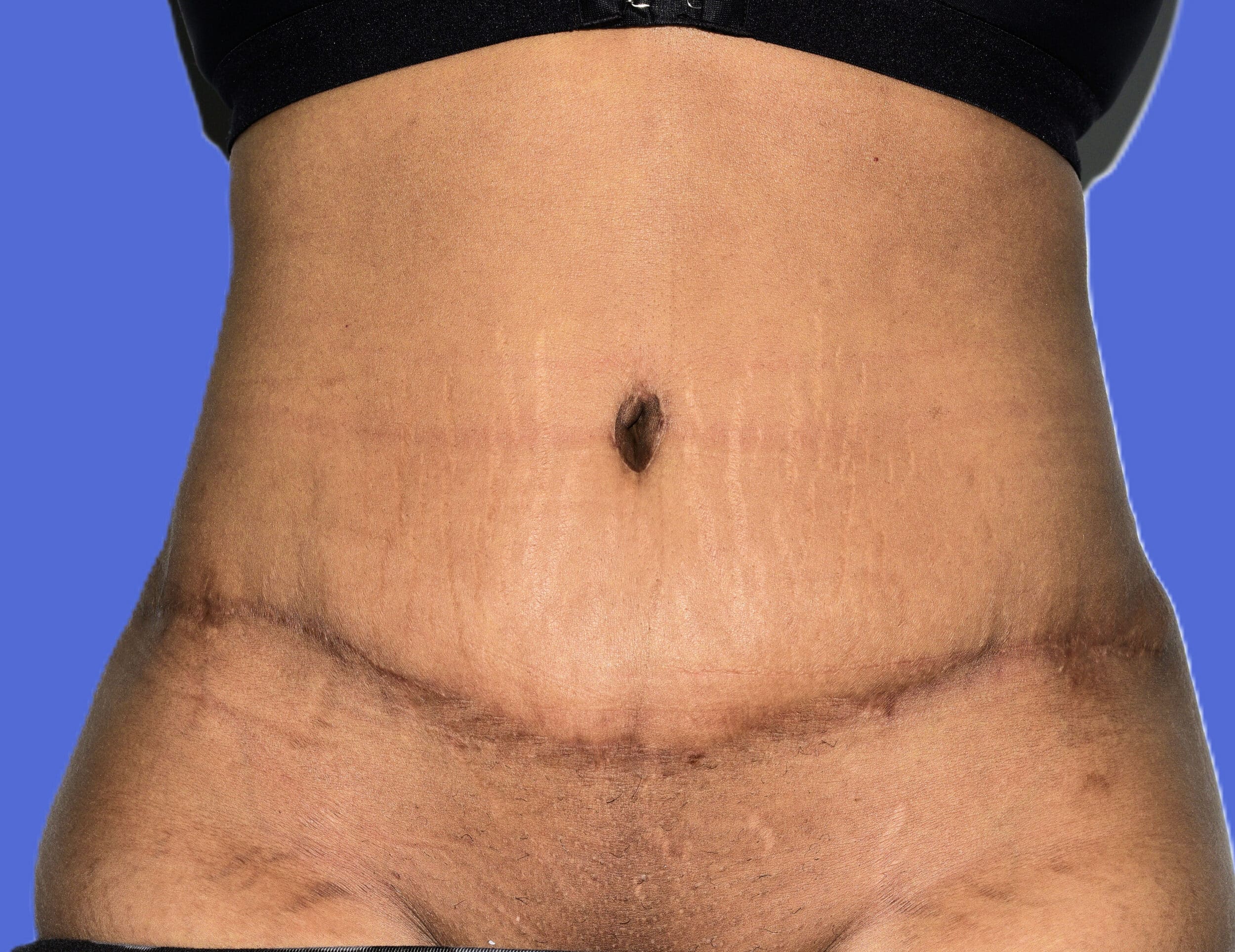 After Image: Tummy Tuck After Abdominal Liposuction - front
