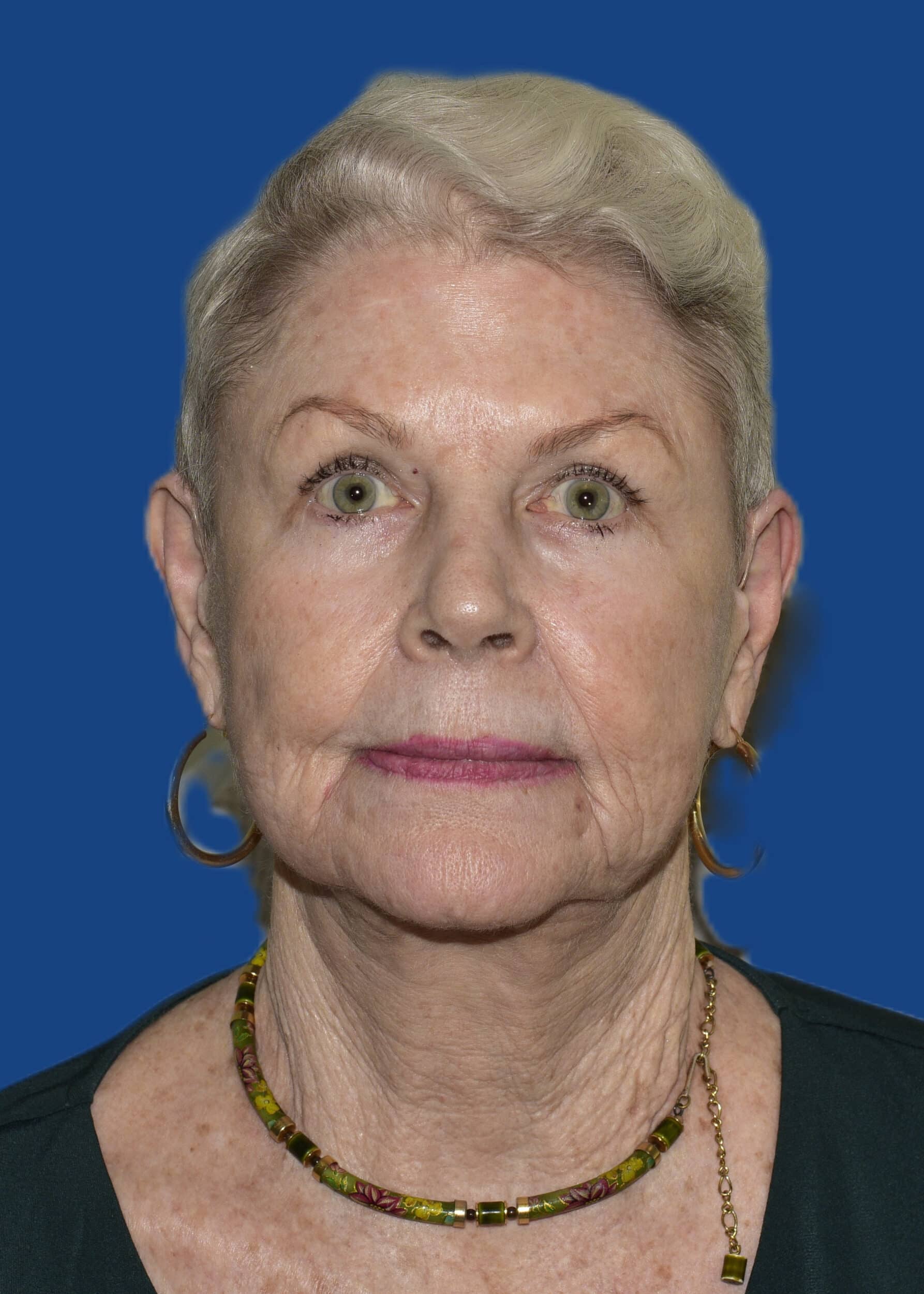 After Image: Face/Neck Lift - front