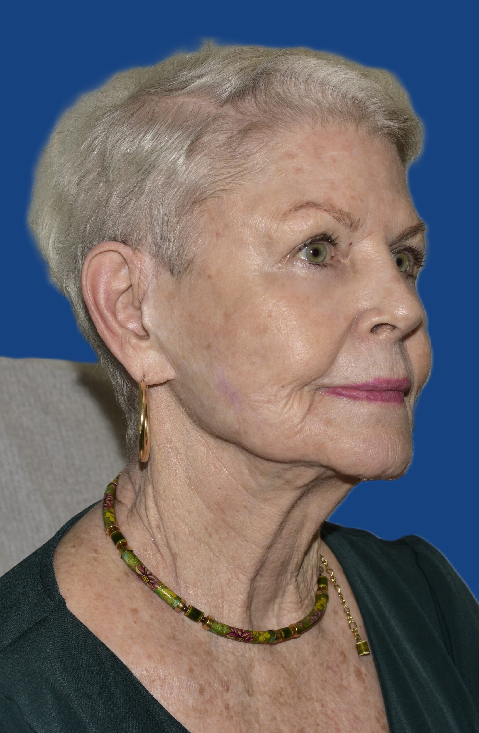 After Image: Face/Neck Lift - right-front-oblique