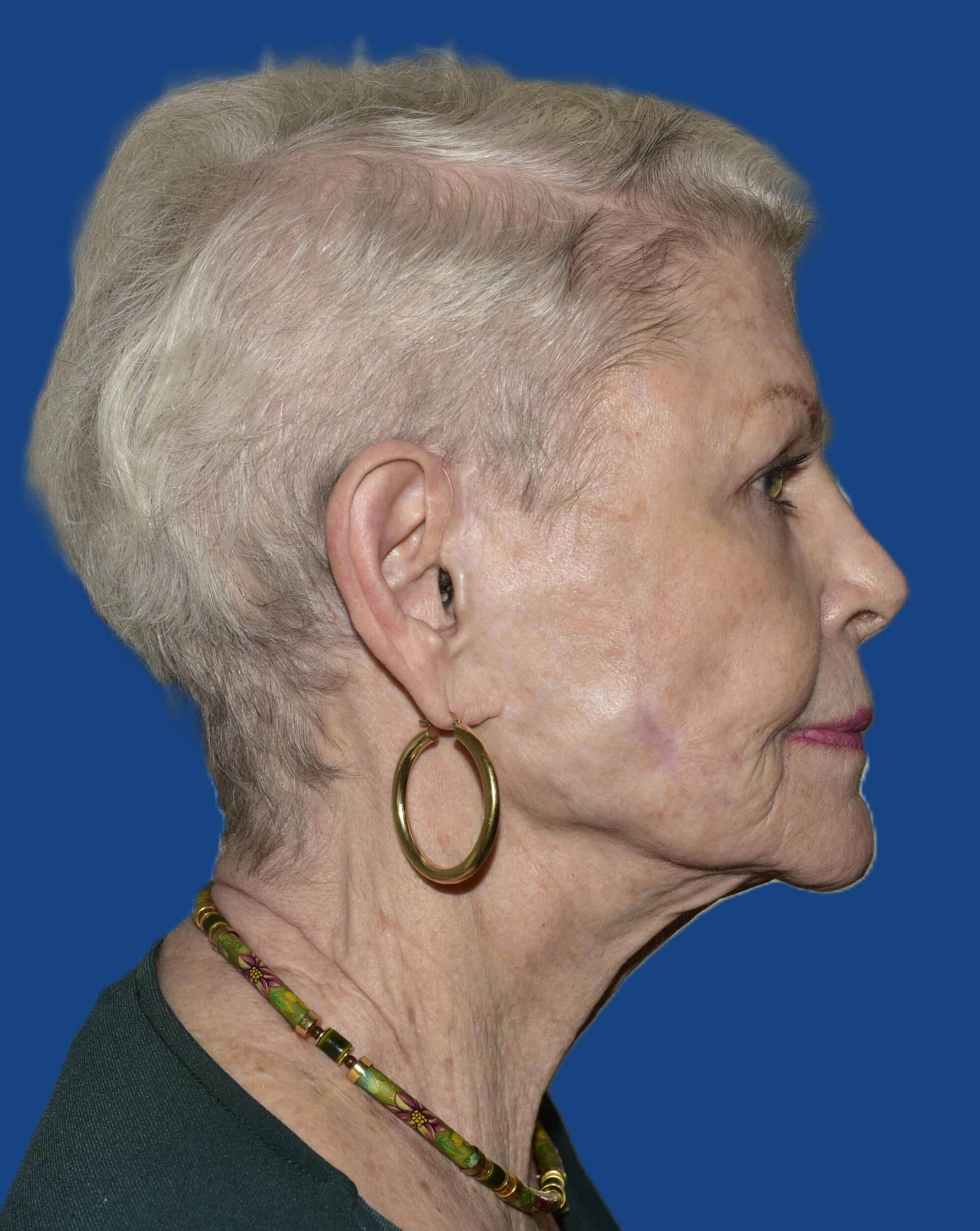 After Image: Face/Neck Lift - right-side