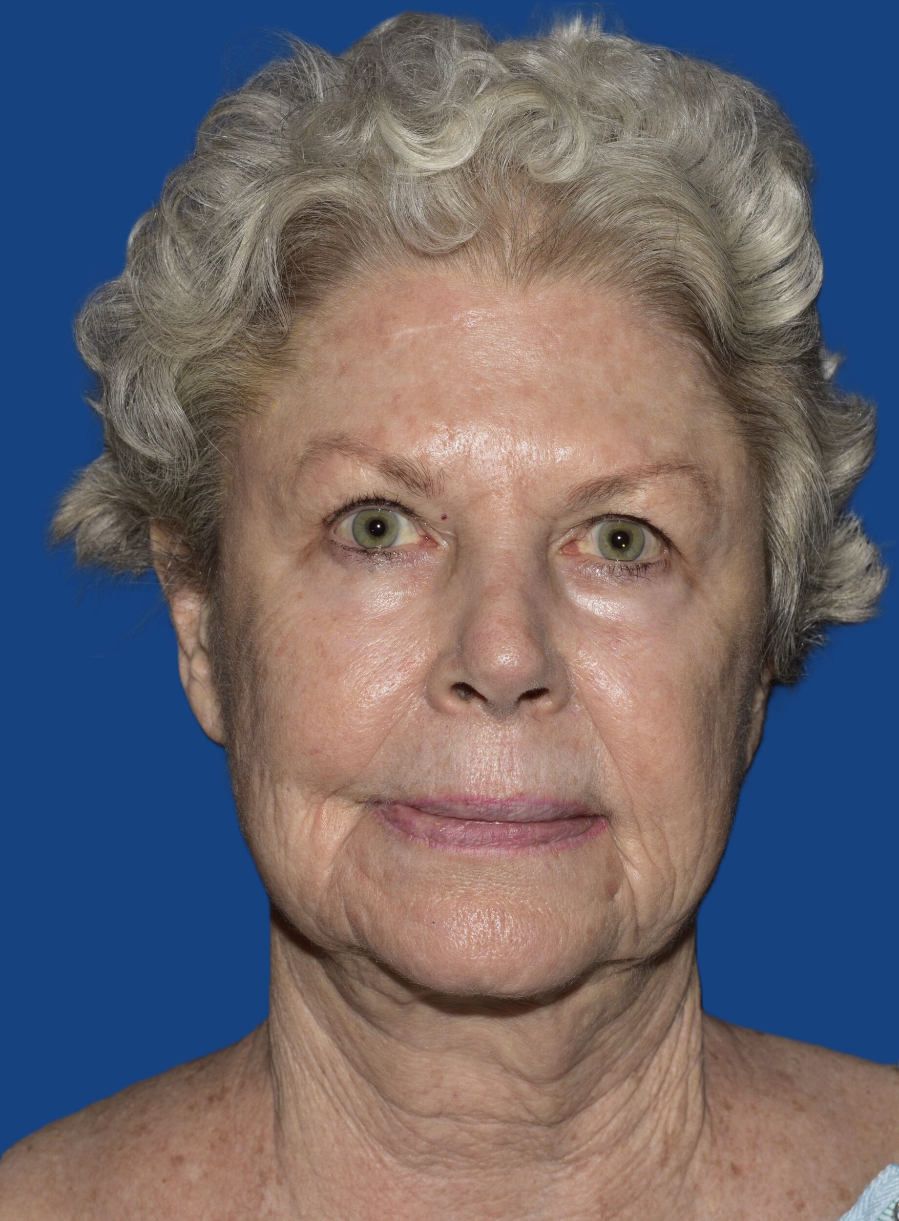 Before Image: Face/Neck Lift - front
