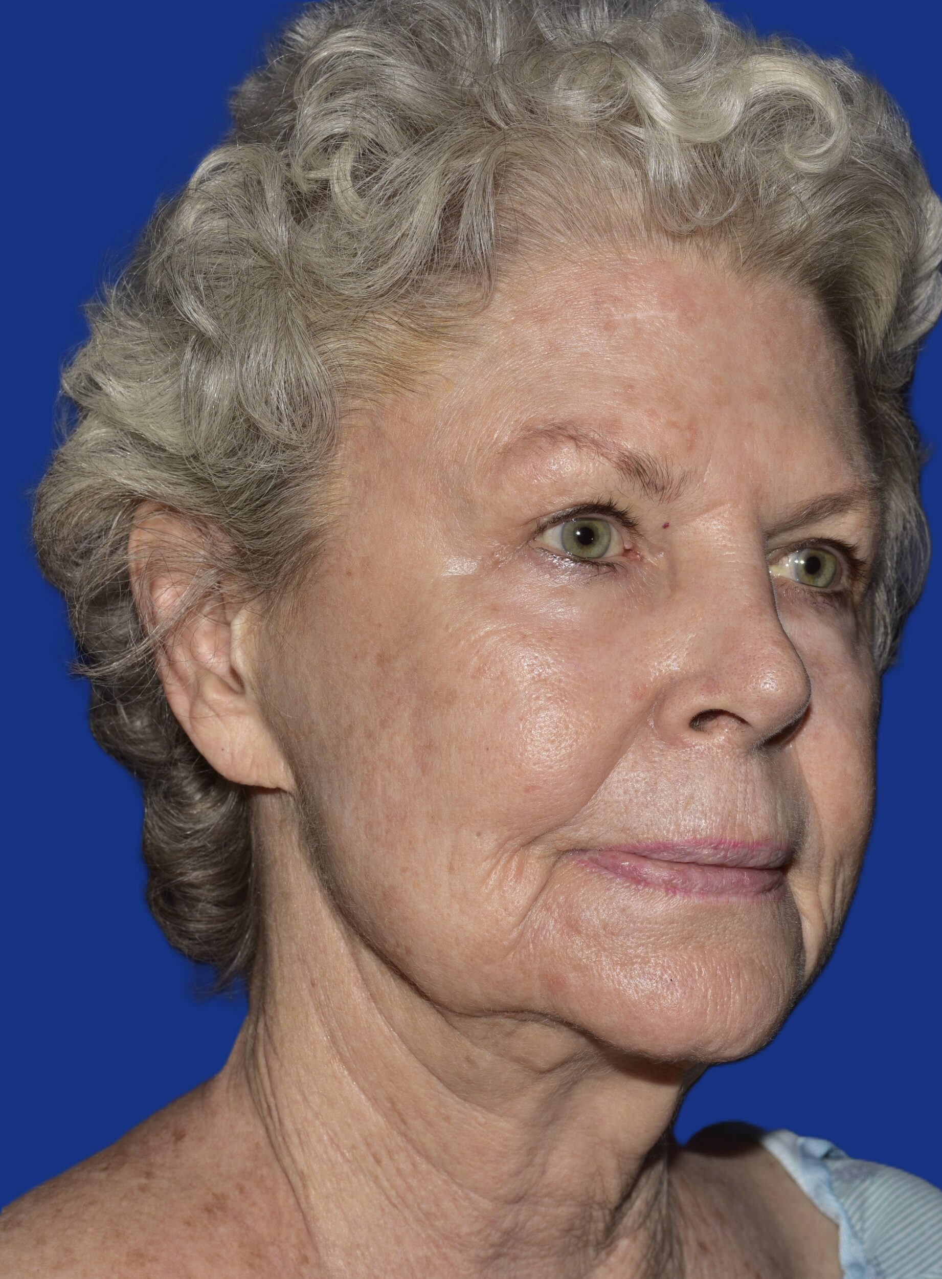 Before Image: Face/Neck Lift - right-front-oblique