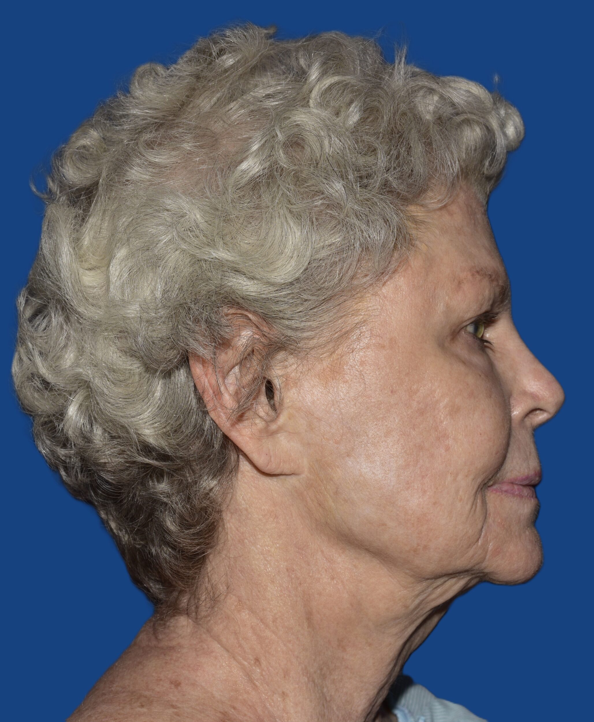 Before Image: Face/Neck Lift - right-side