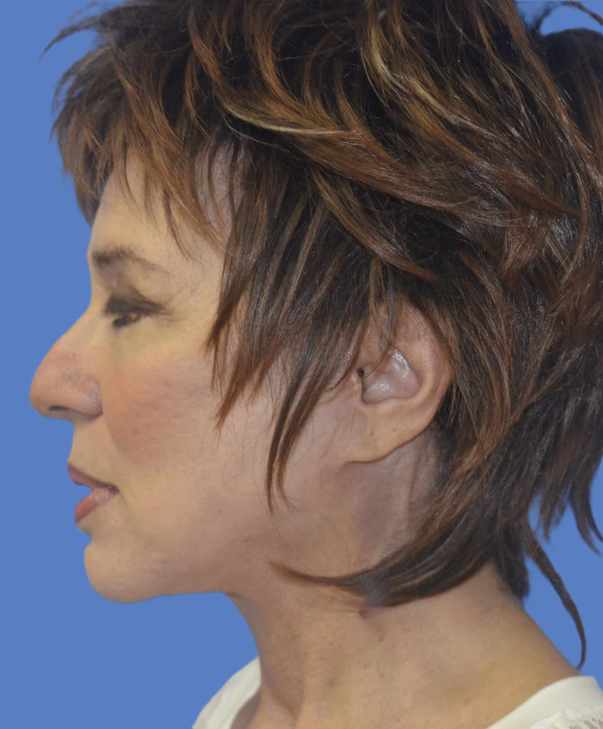 After Image: Face/Neck Lift - left-side