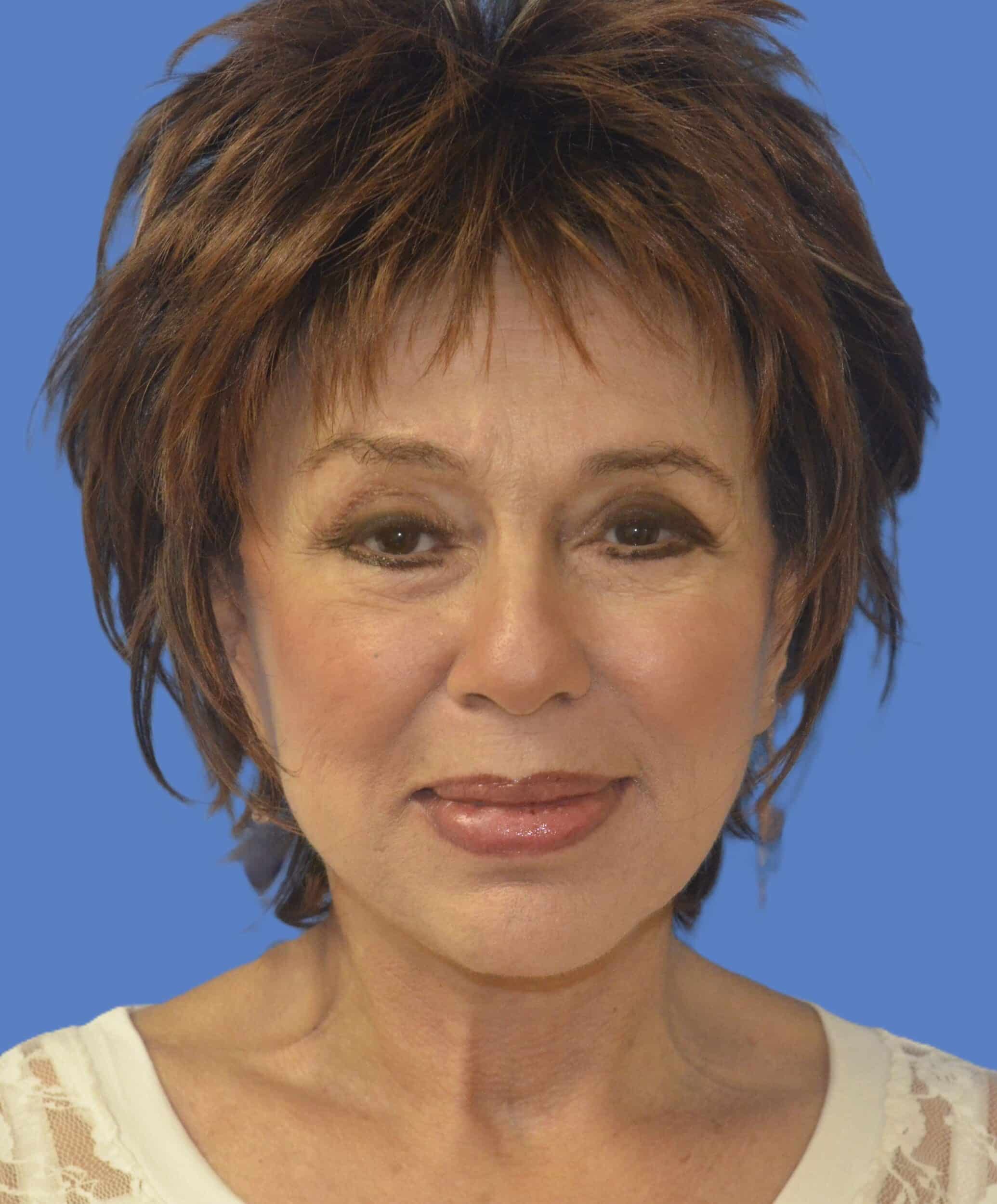 After Image: Face/Neck Lift - front