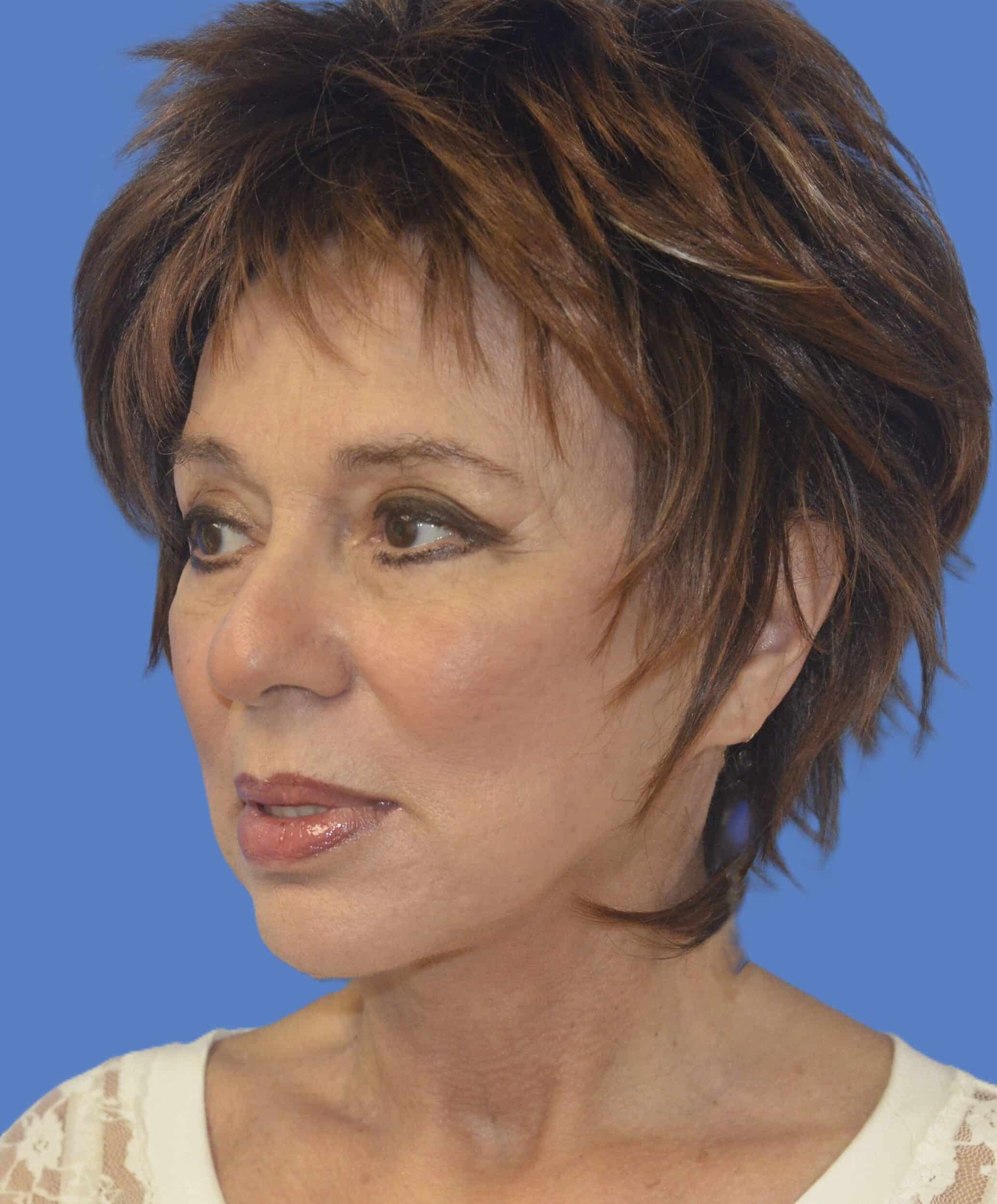 After Image: Face/Neck Lift - left-front-oblique
