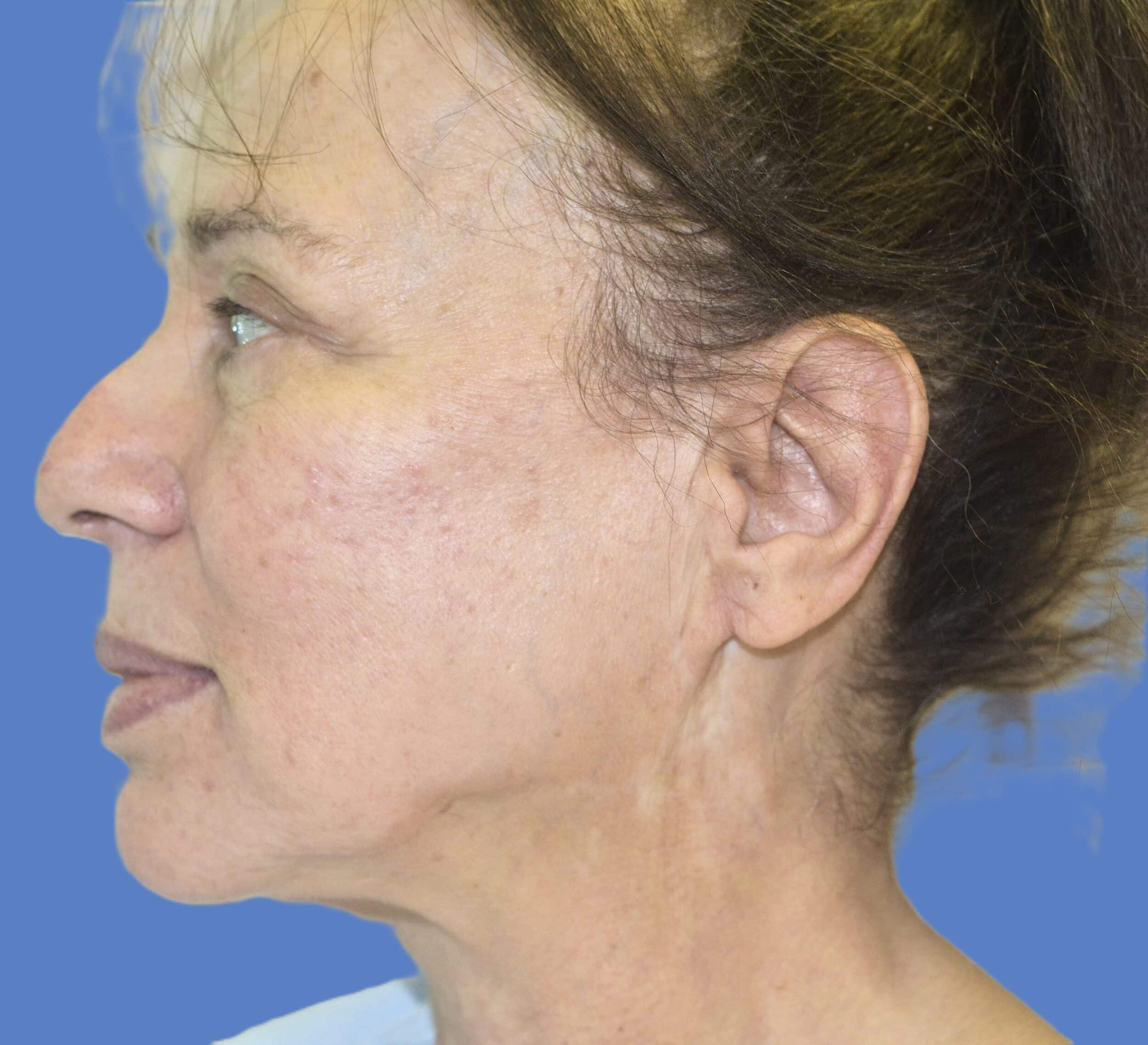 Before Image: Face/Neck Lift - left-side