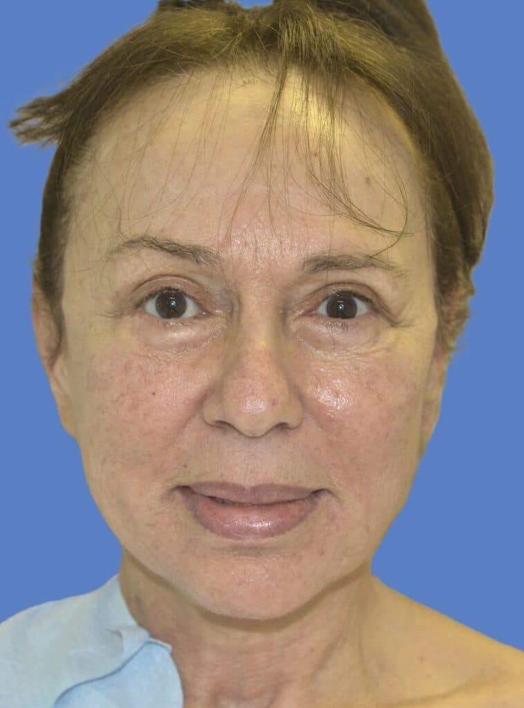 Before Image: Face/Neck Lift - front