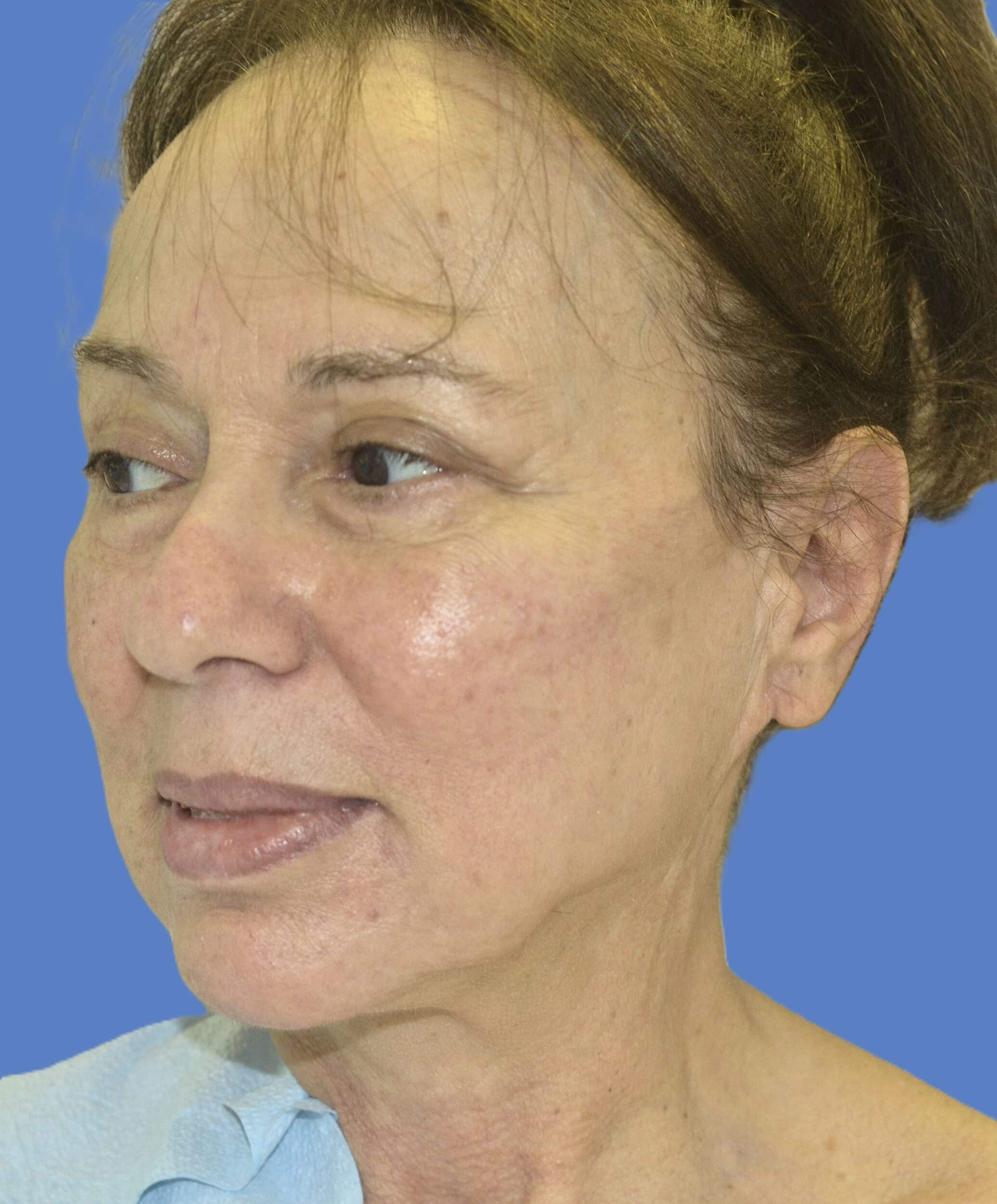 Before Image: Face/Neck Lift - left-front-oblique