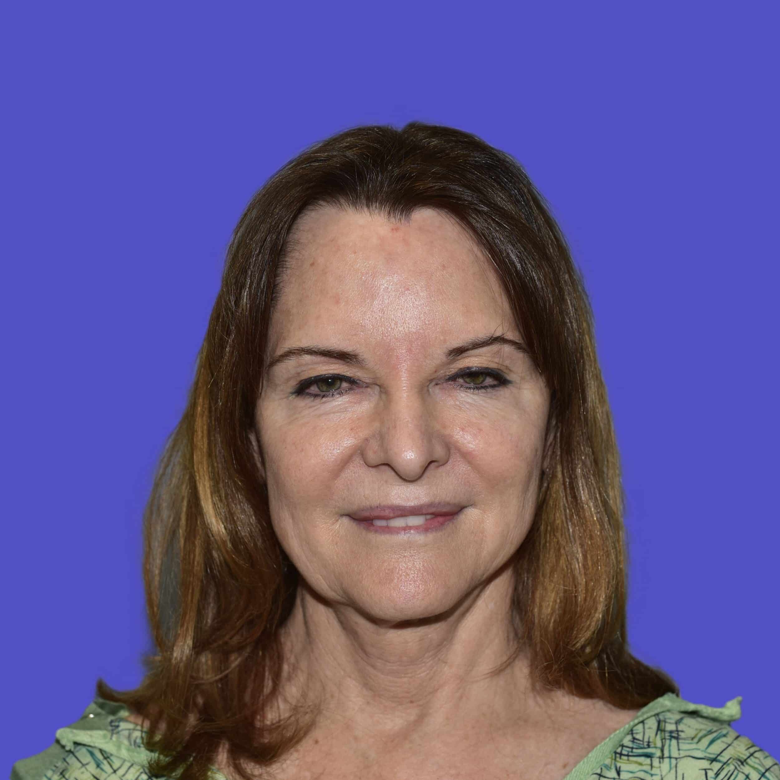 Before Image: Facelift - front