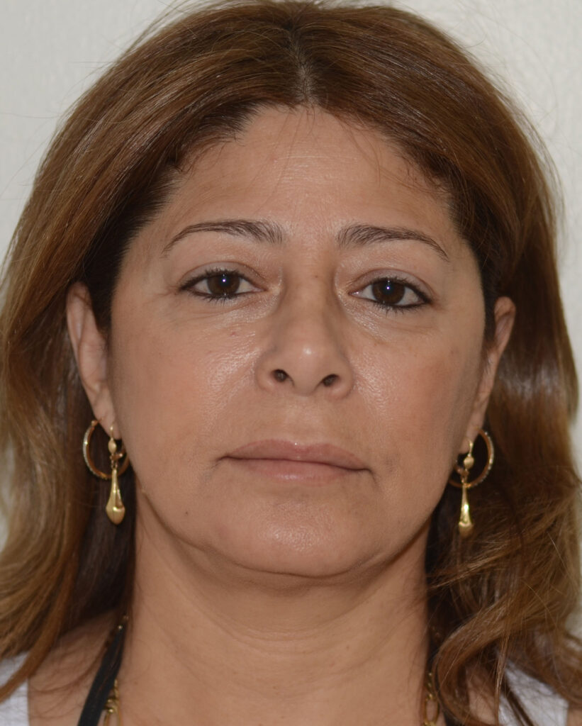 After Image: Facelift - front