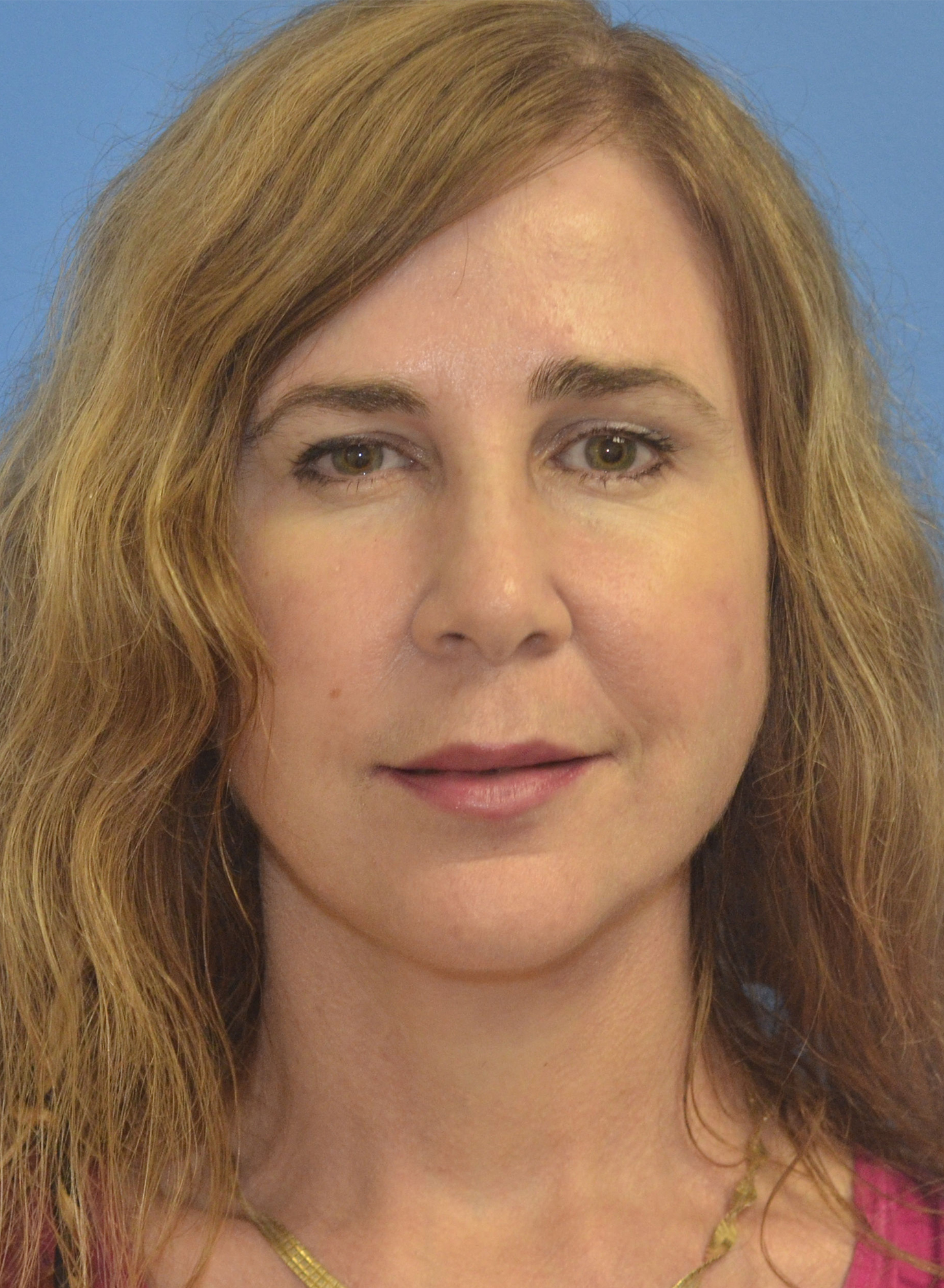 After Image: Facelift - front