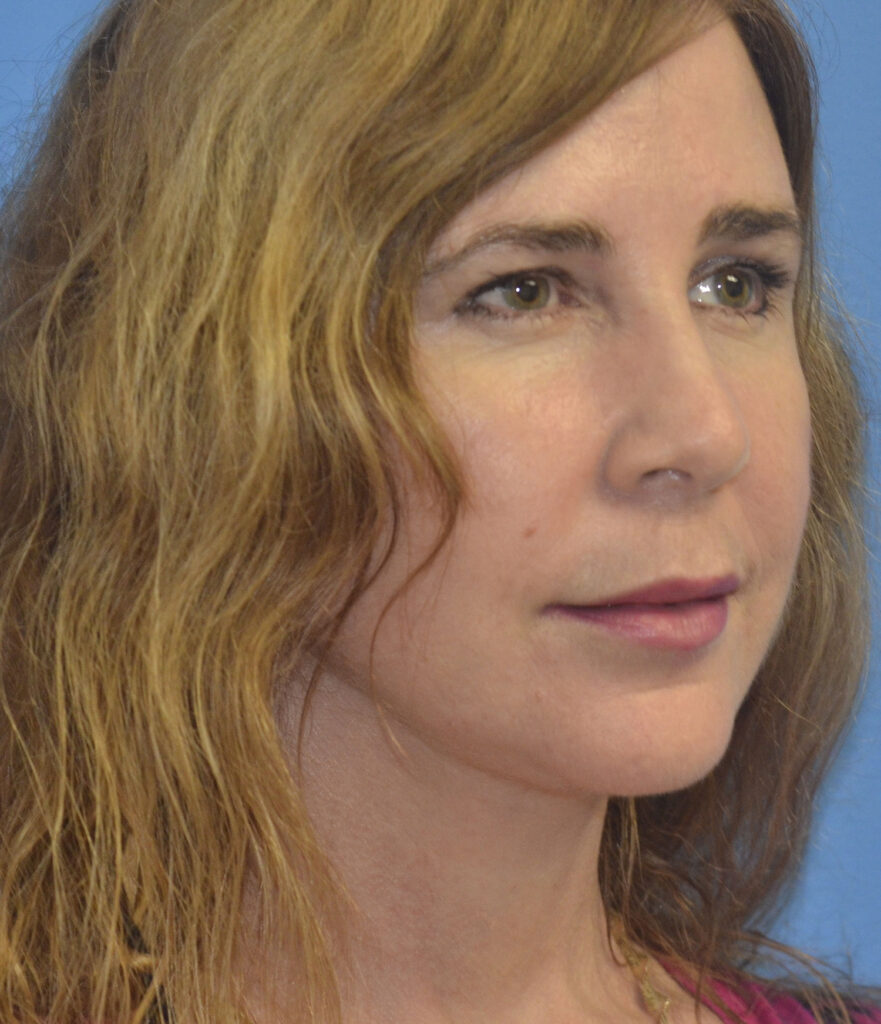 After Image: Facelift - right-front-oblique