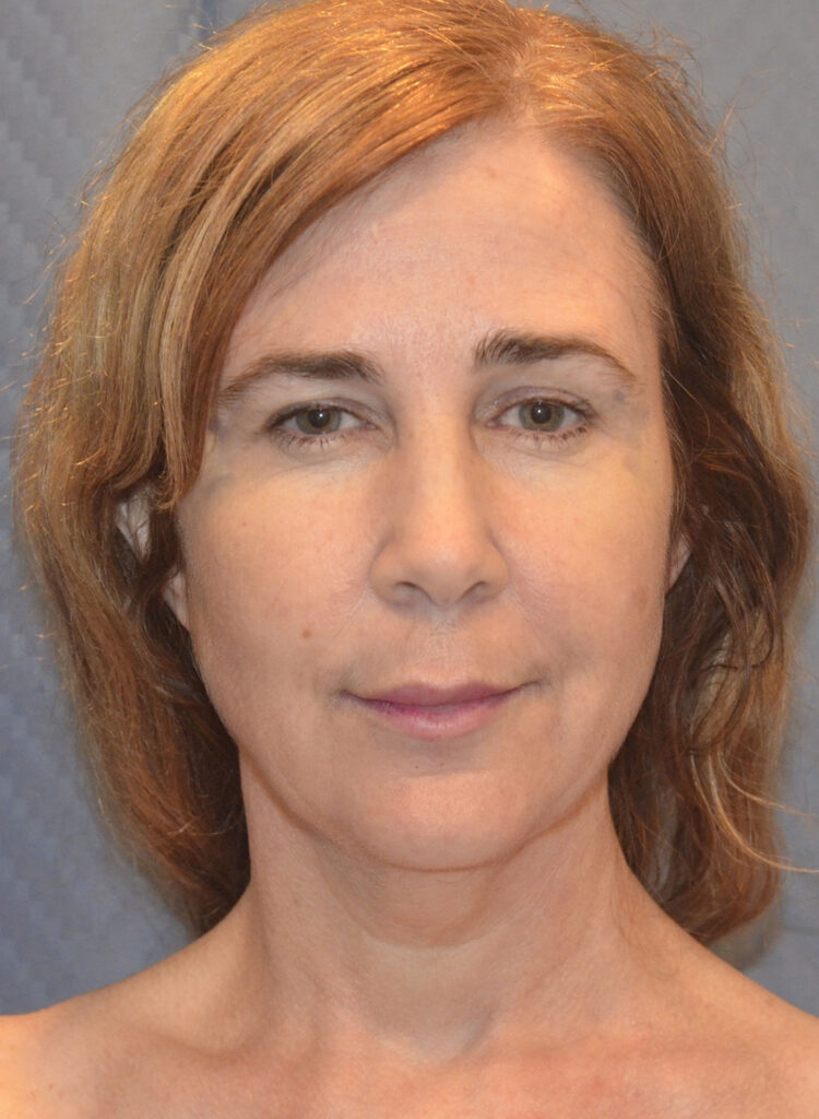 Before Image: Facelift - front