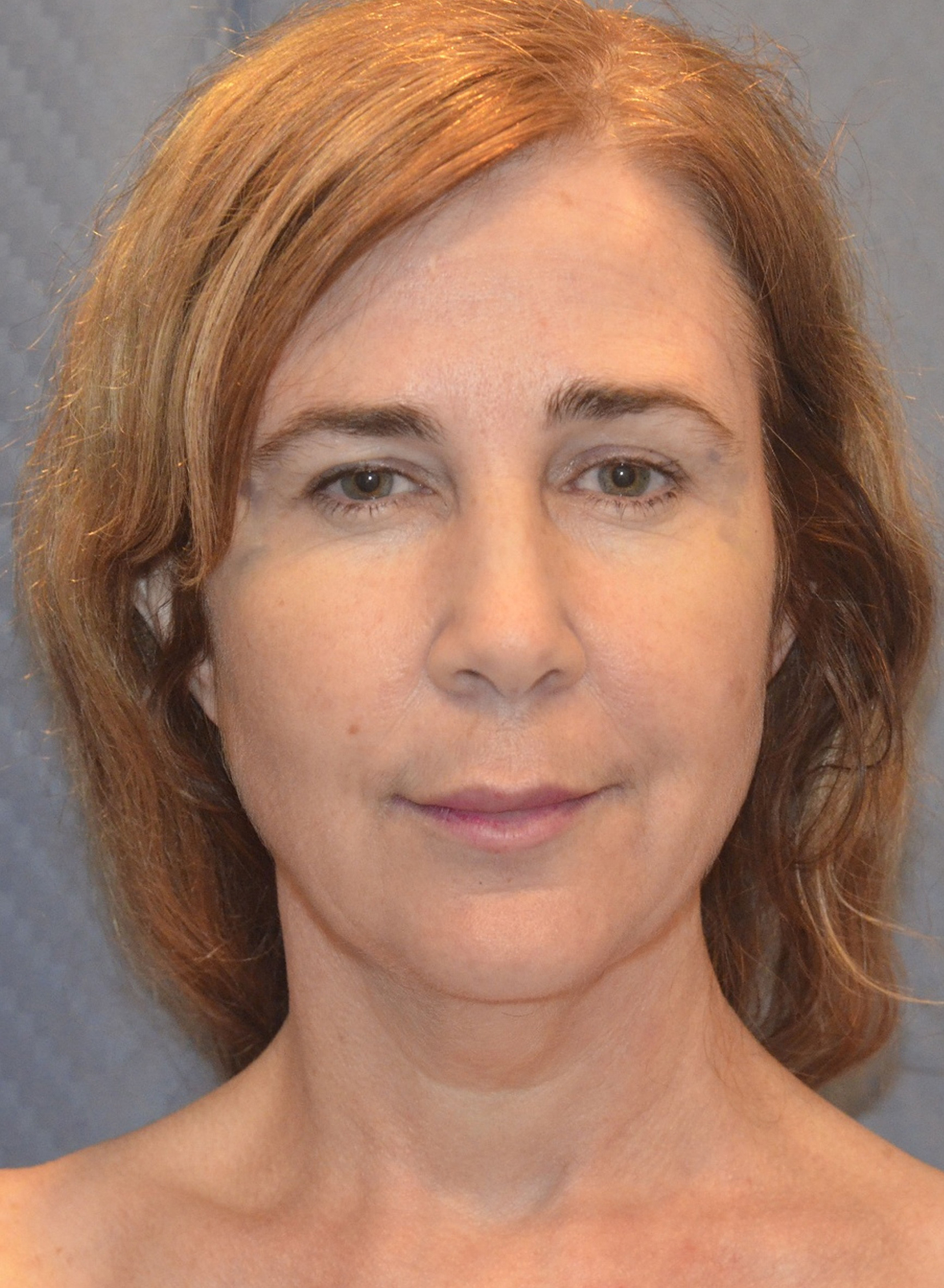 Before Image: Facelift - front