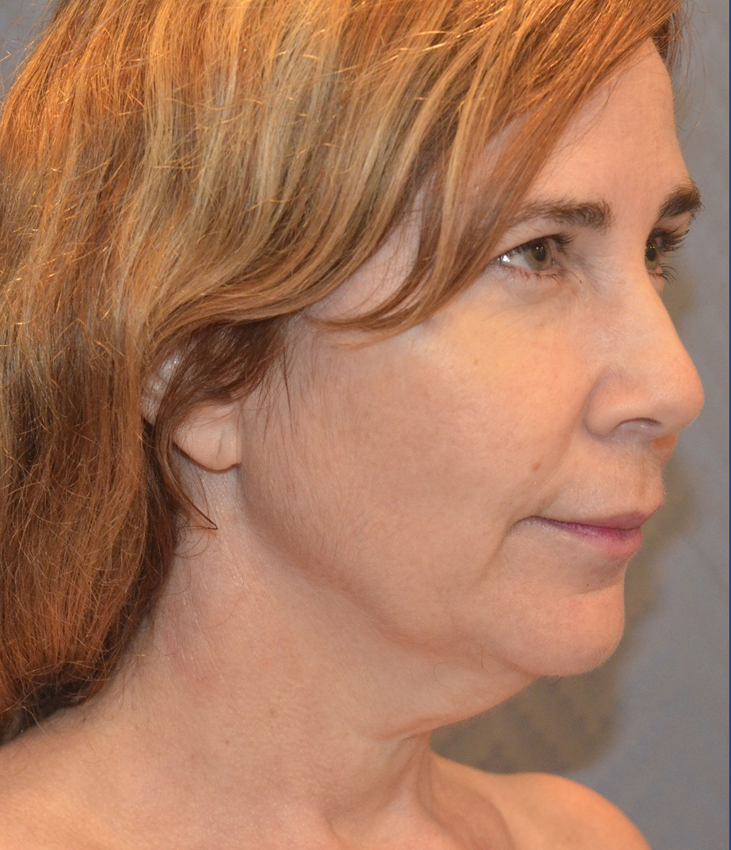 Before Image: Facelift - right-front-oblique