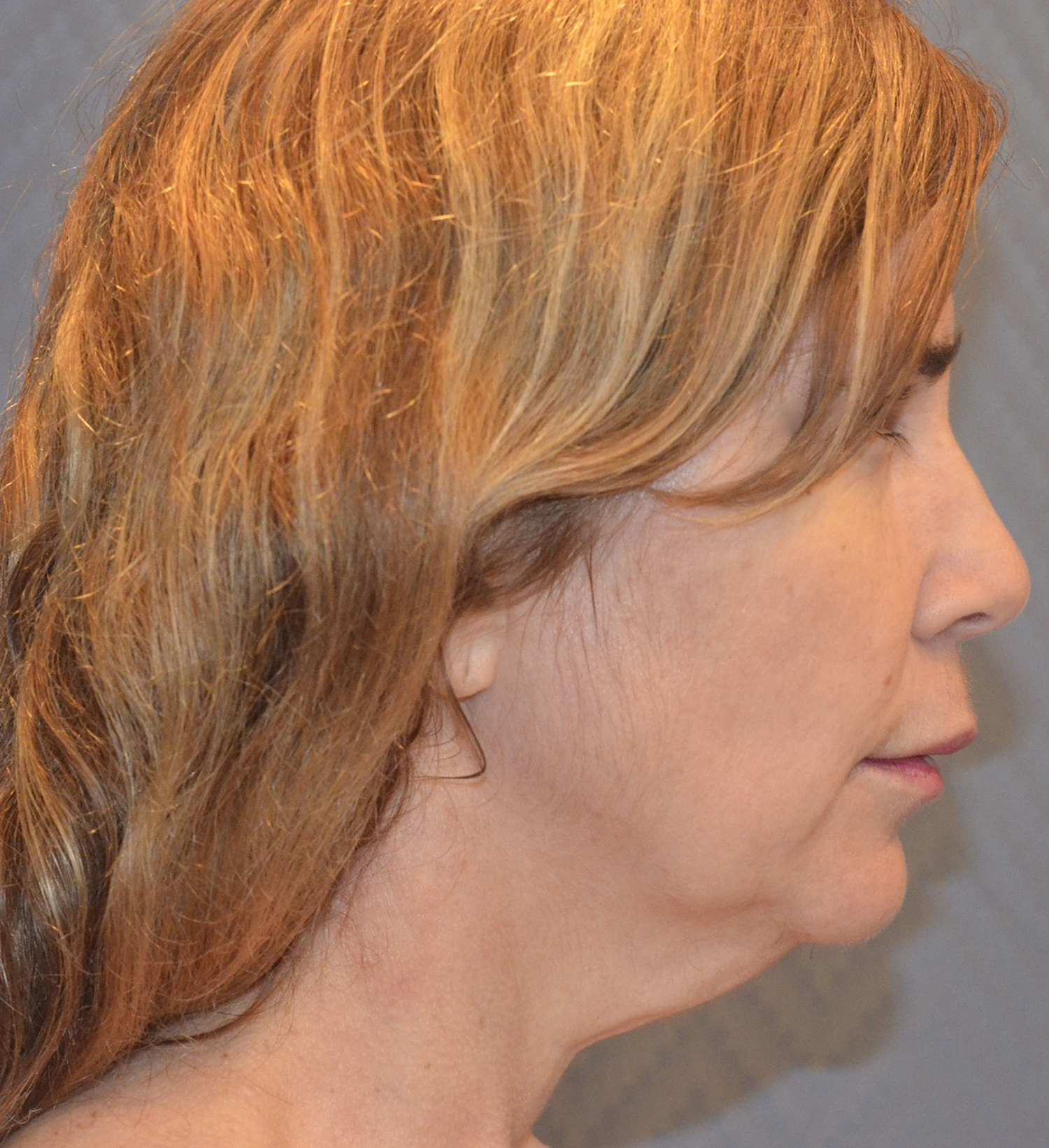 Before Image: Facelift - right-side