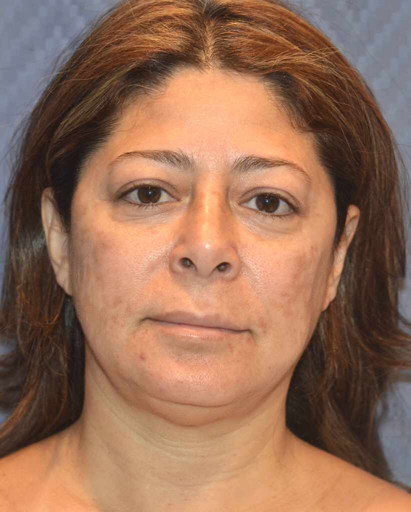 Before Image: Facelift - front