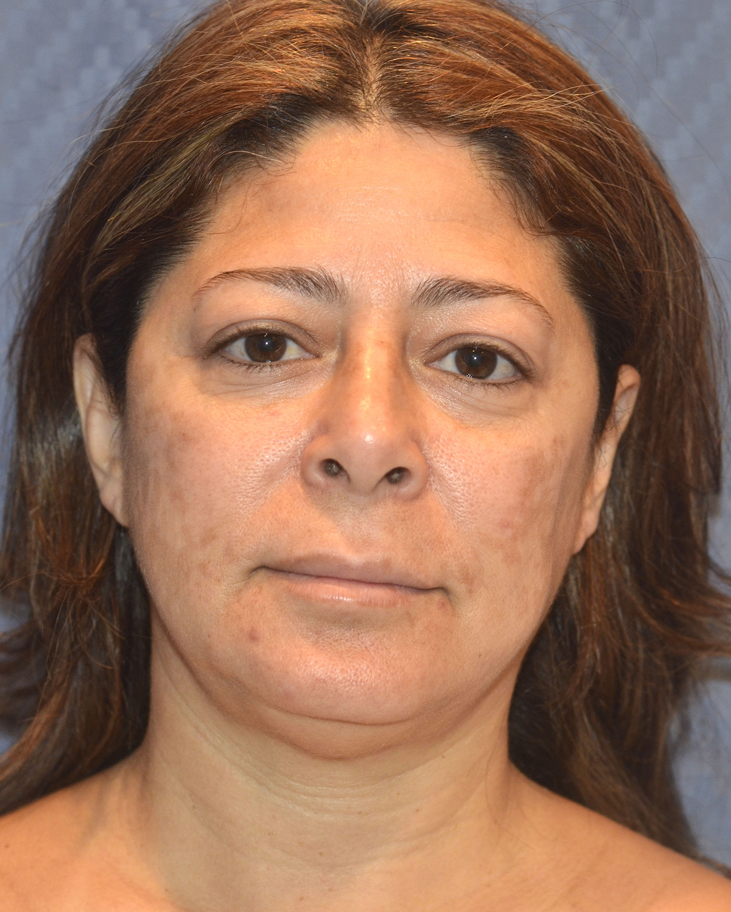 Before Image: Facelift - front