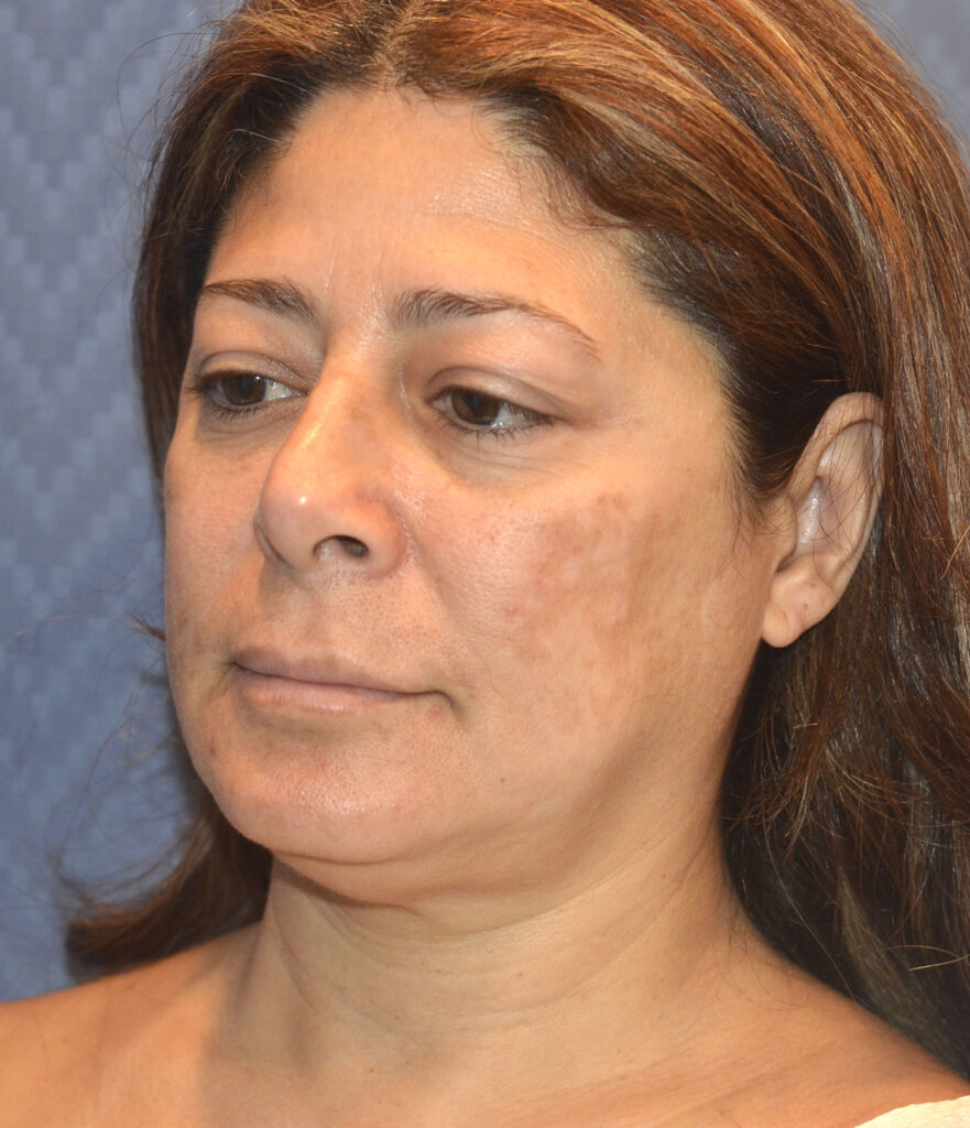 Before Image: Facelift - left-front-oblique