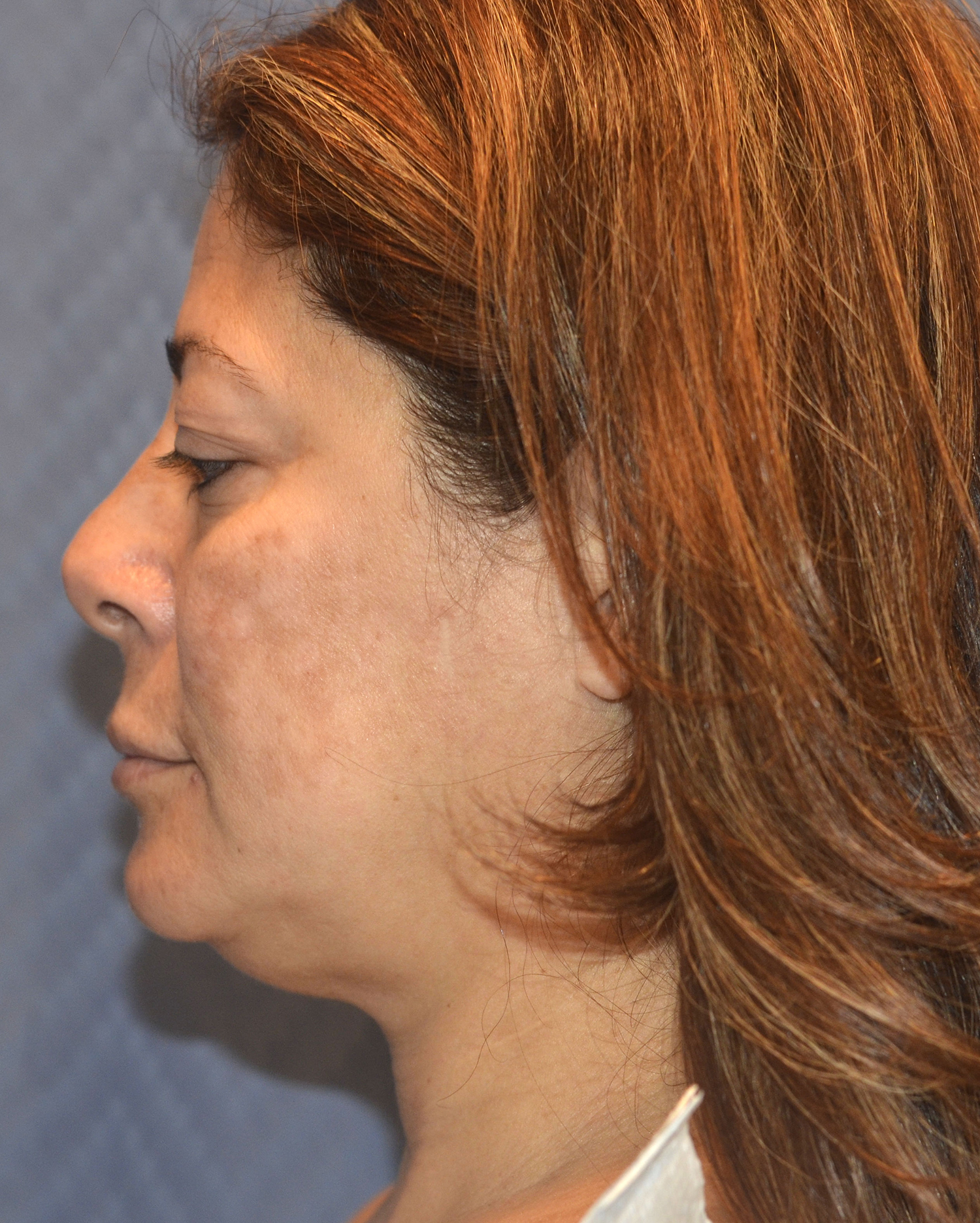 Before Image: Facelift - left-side