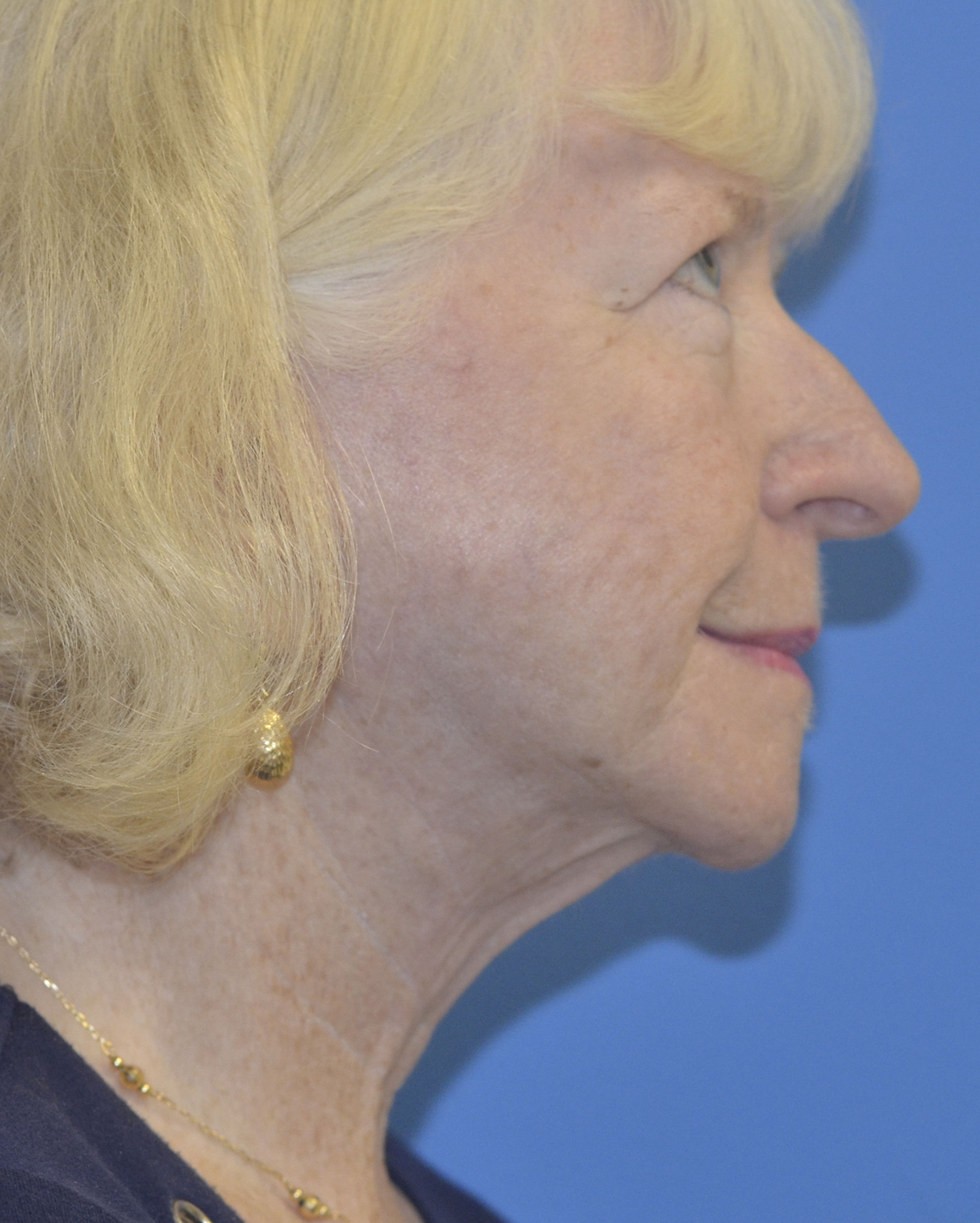 After Image: Facelift - right-side