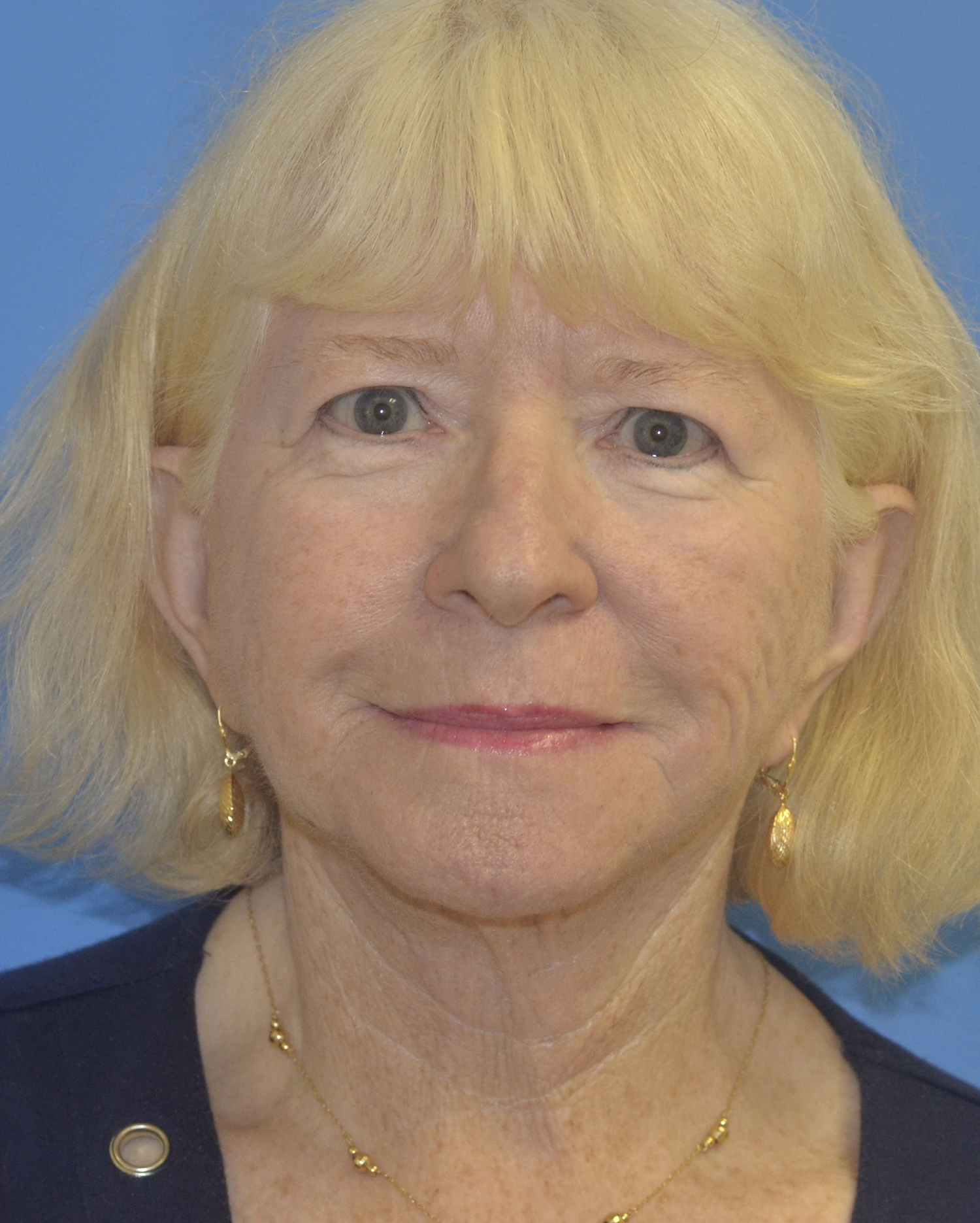 After Image: Facelift - front