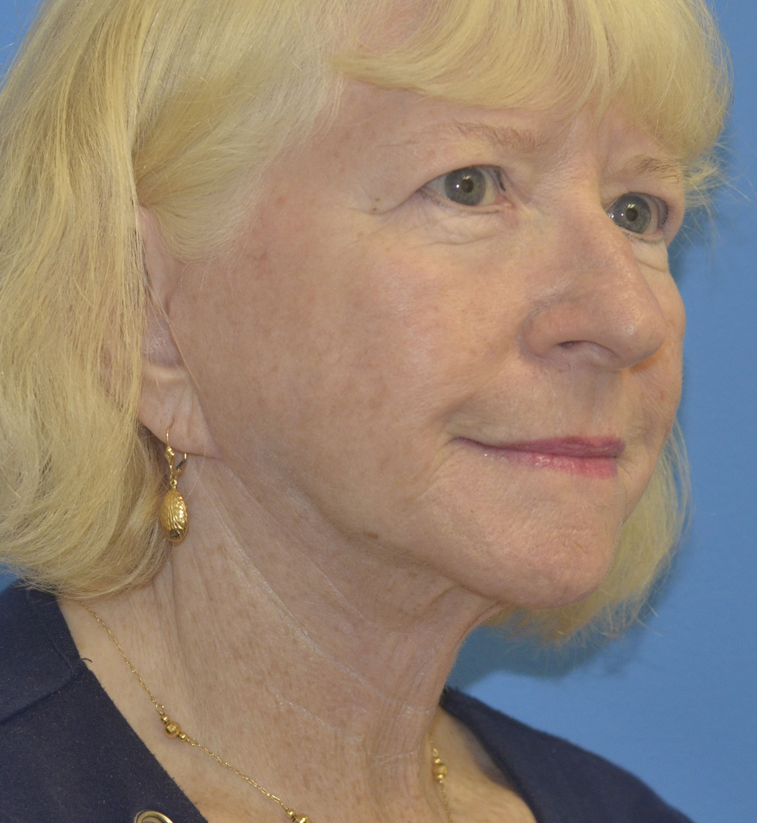 After Image: Facelift - right-front-oblique