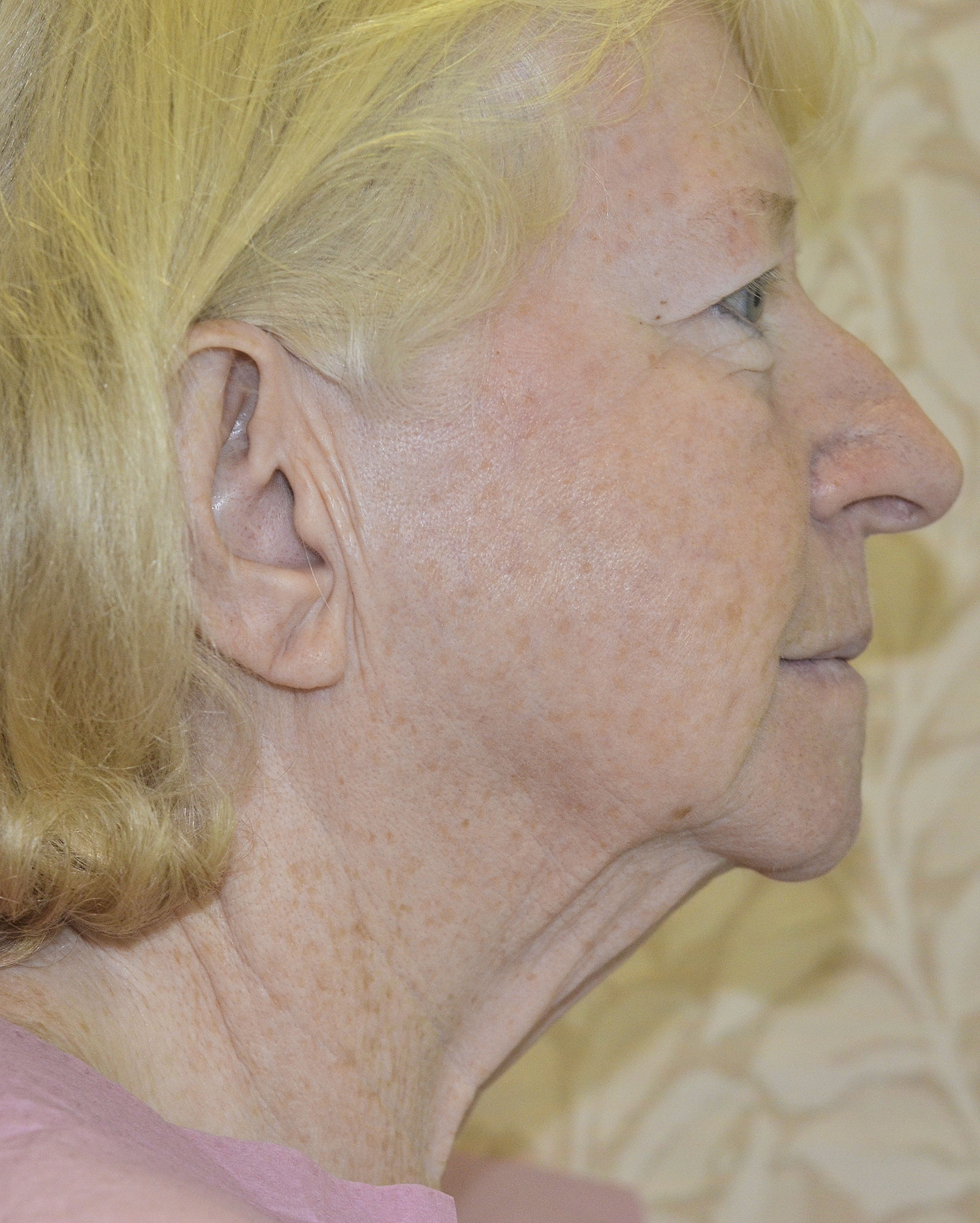 Before Image: Facelift - right-side