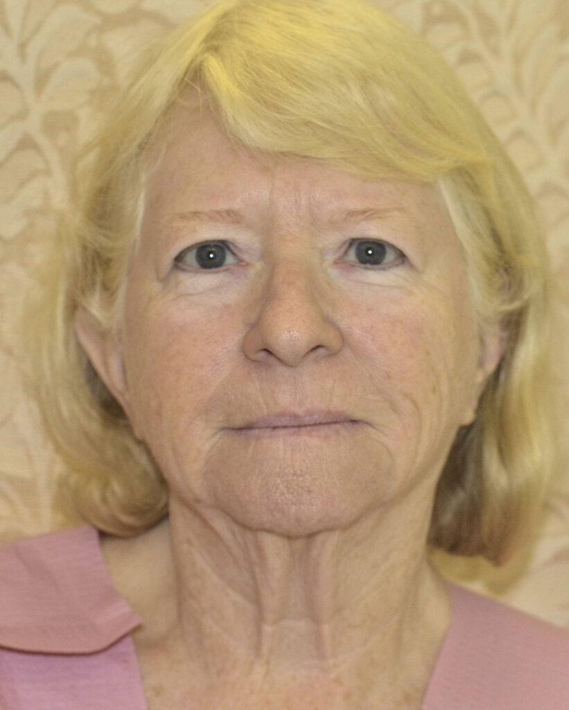 Before Image: Facelift - front