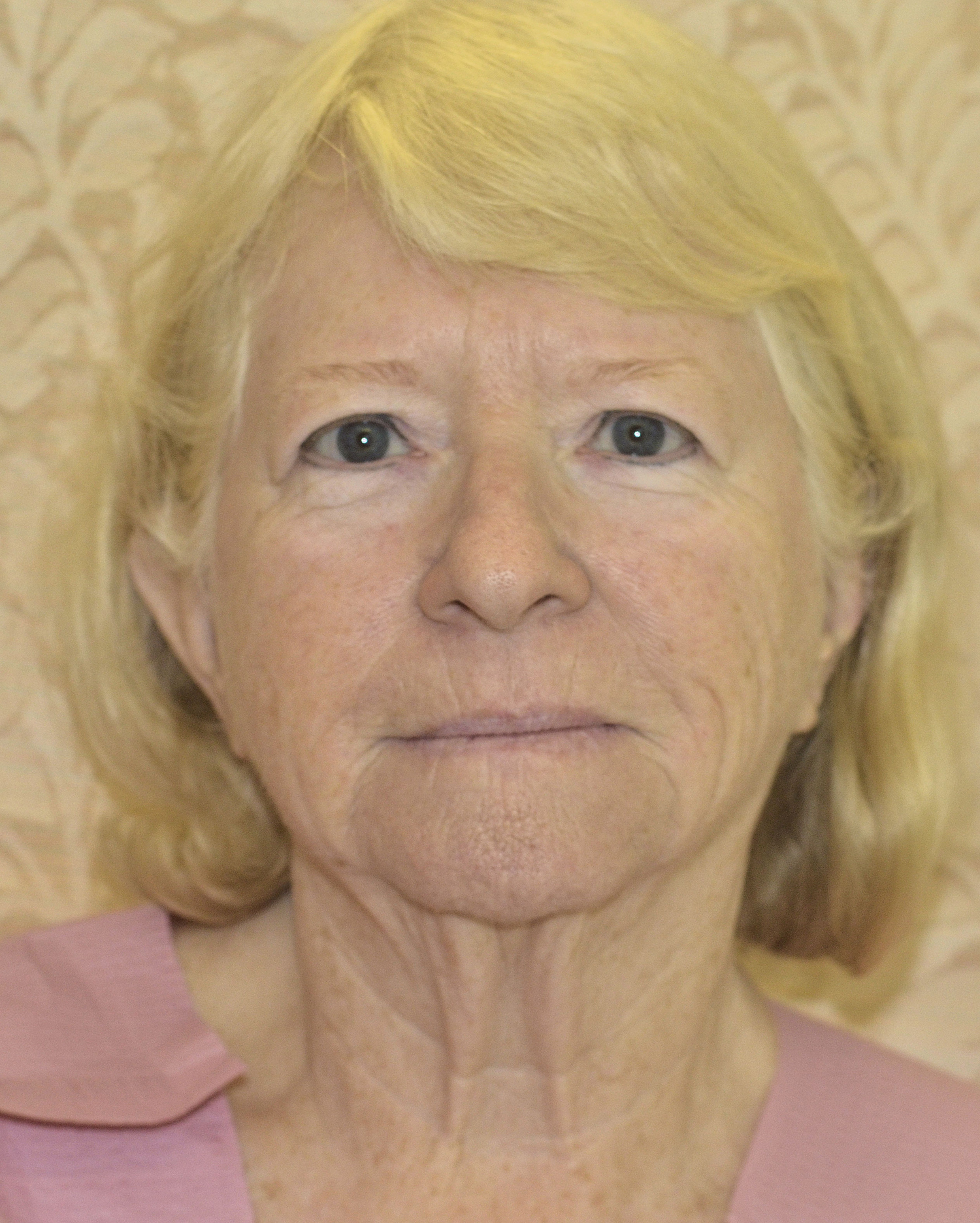 Before Image: Facelift - front