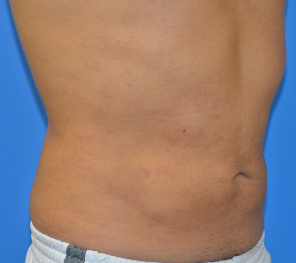 After Image: Liposuction - right-front-oblique