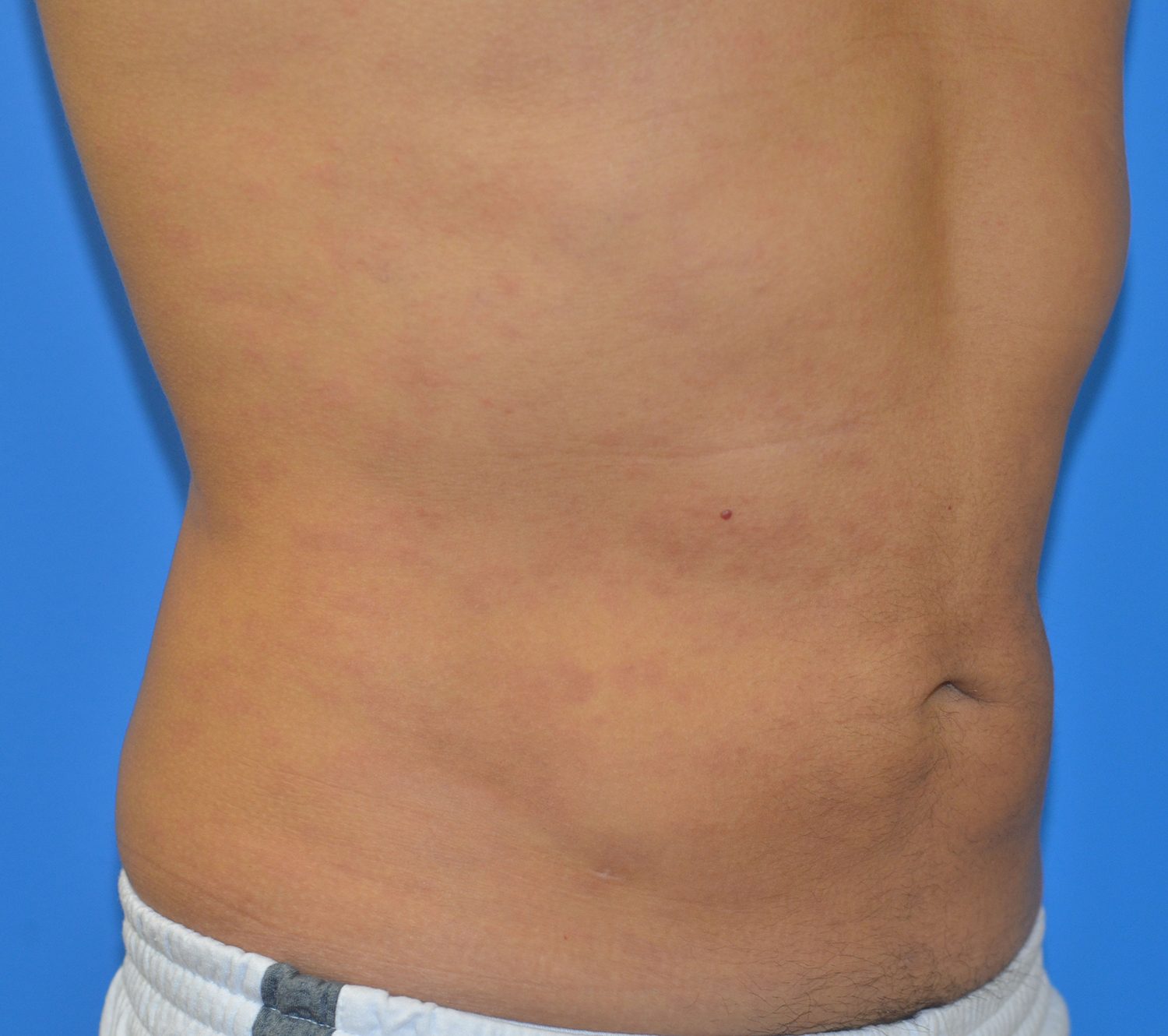 After Image: Liposuction - right-front-oblique